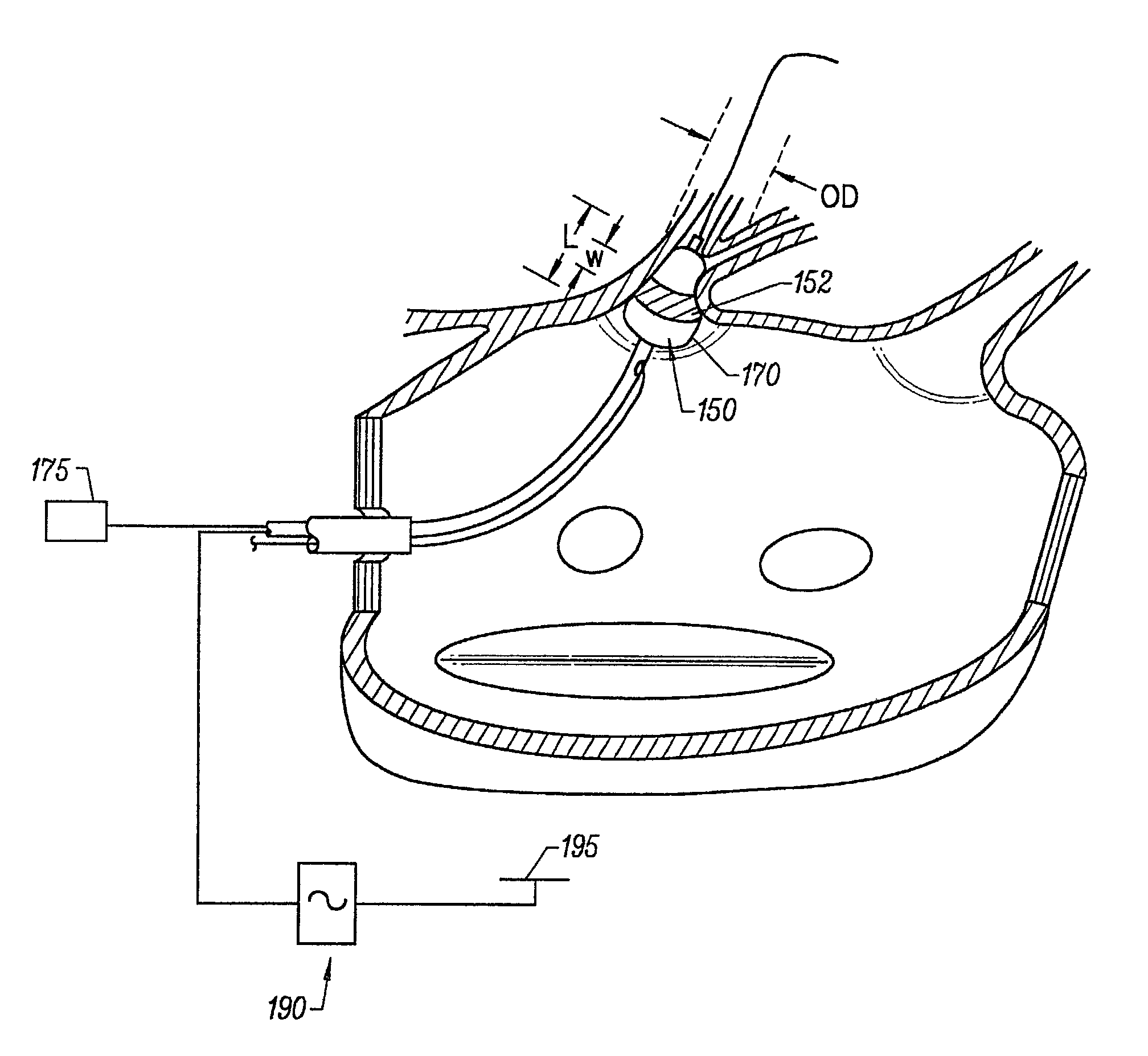 Device and method for forming a circumferential conduction block in a pulmonary vein