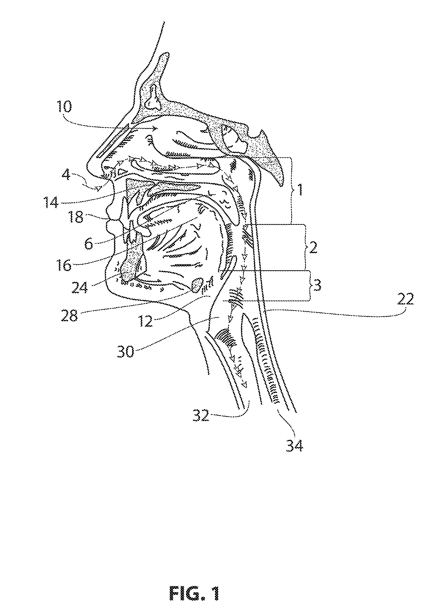 Systems and methods for treatment of sleep apnea