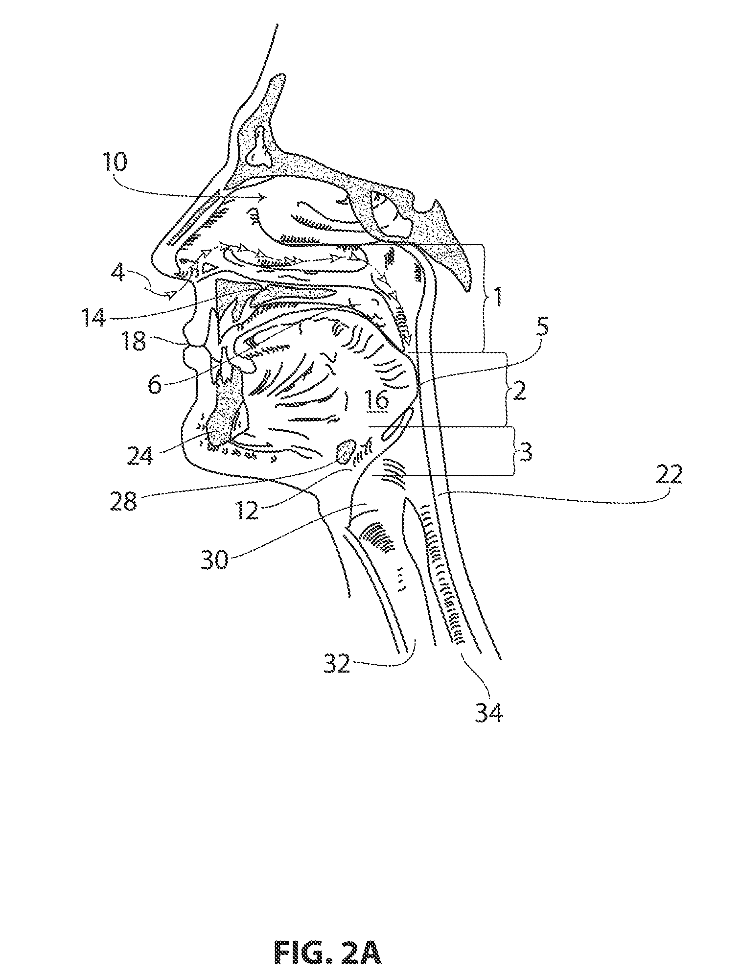 Systems and methods for treatment of sleep apnea