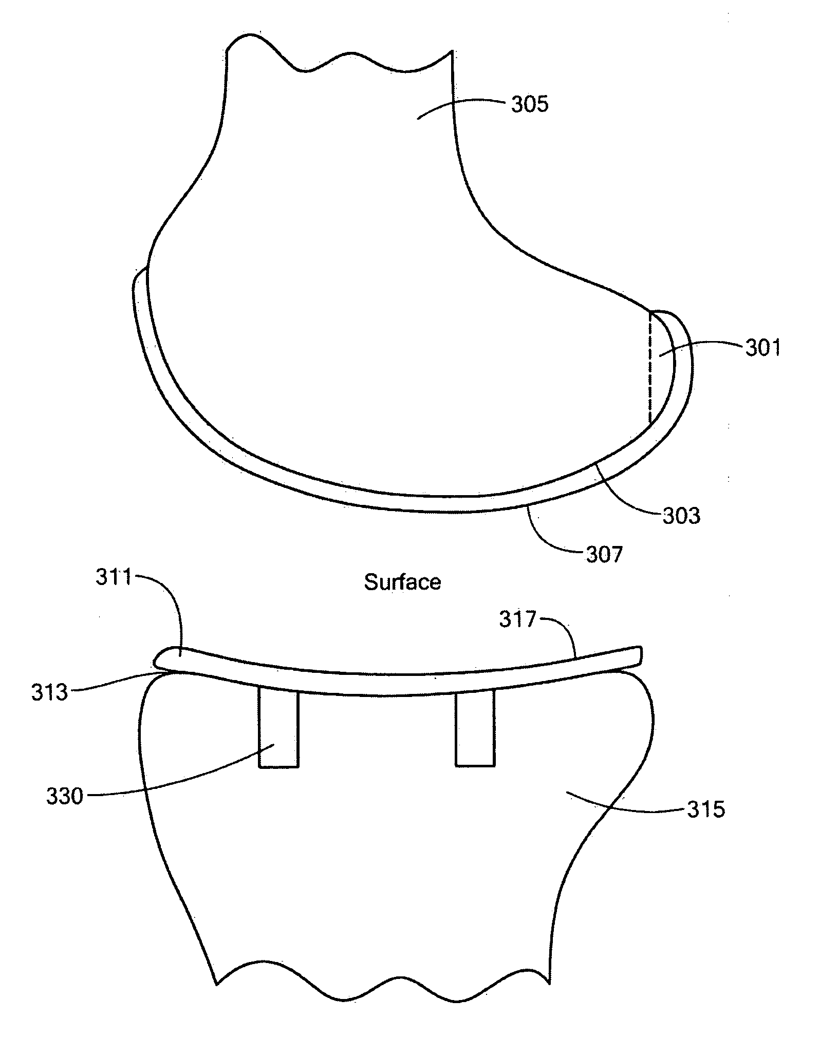 Implant Device and Method for Manufacture