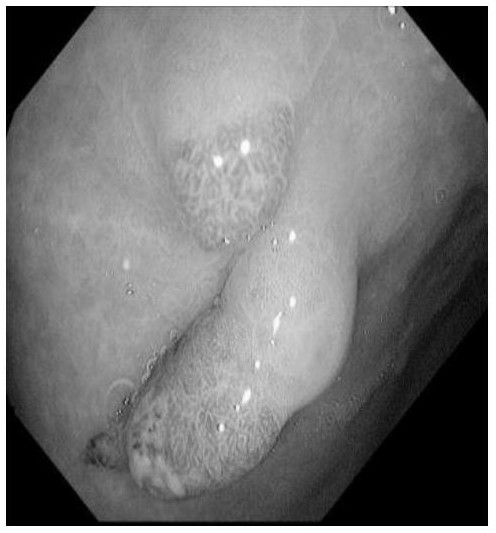 Medical image segmentation method based on highlight spot removal