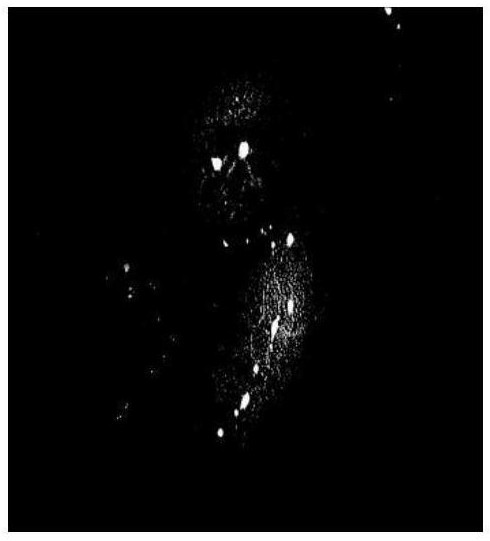 Medical image segmentation method based on highlight spot removal