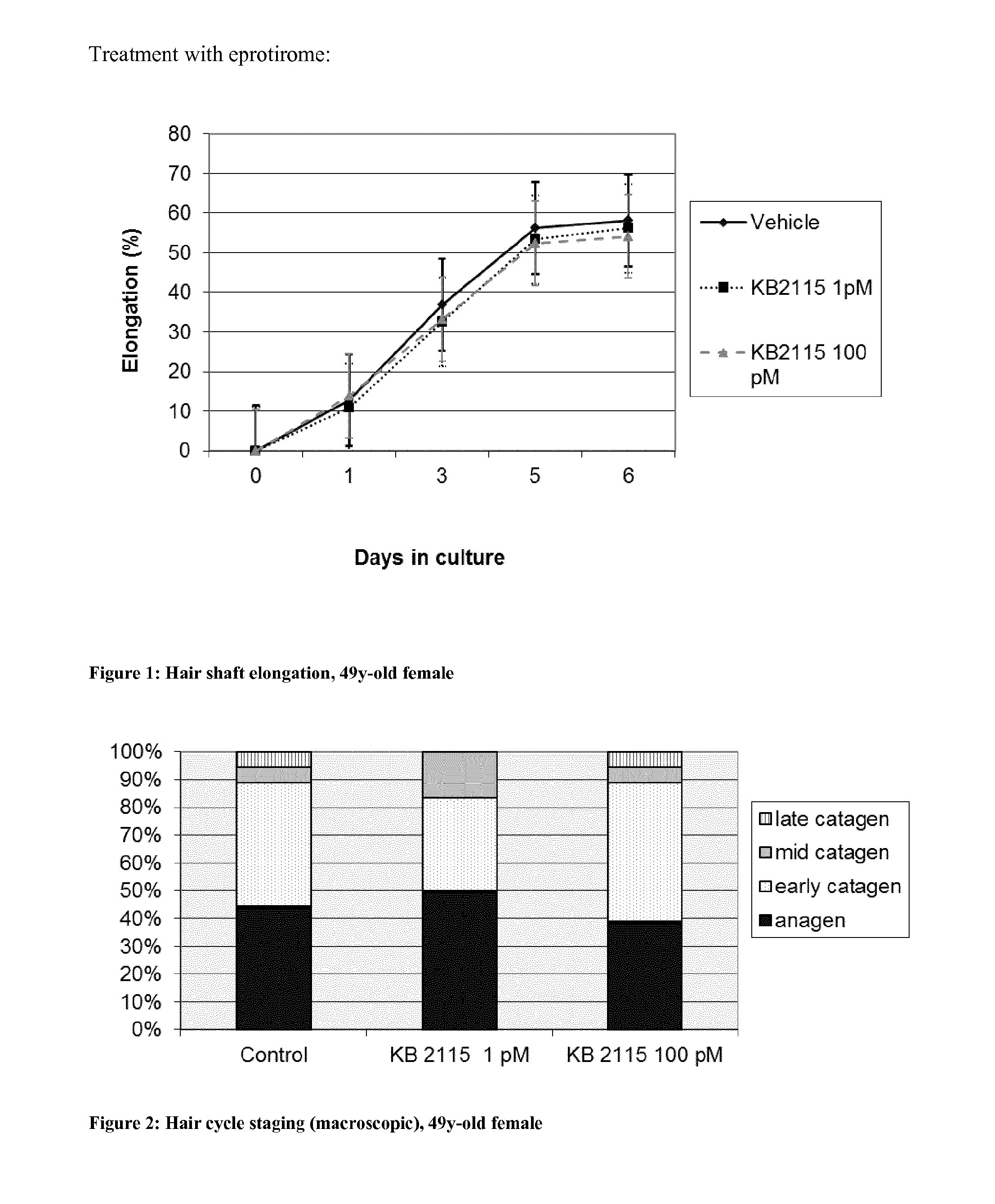Eprotirome for use in the prevention and/or treatment of hair disorders and compositions thereof