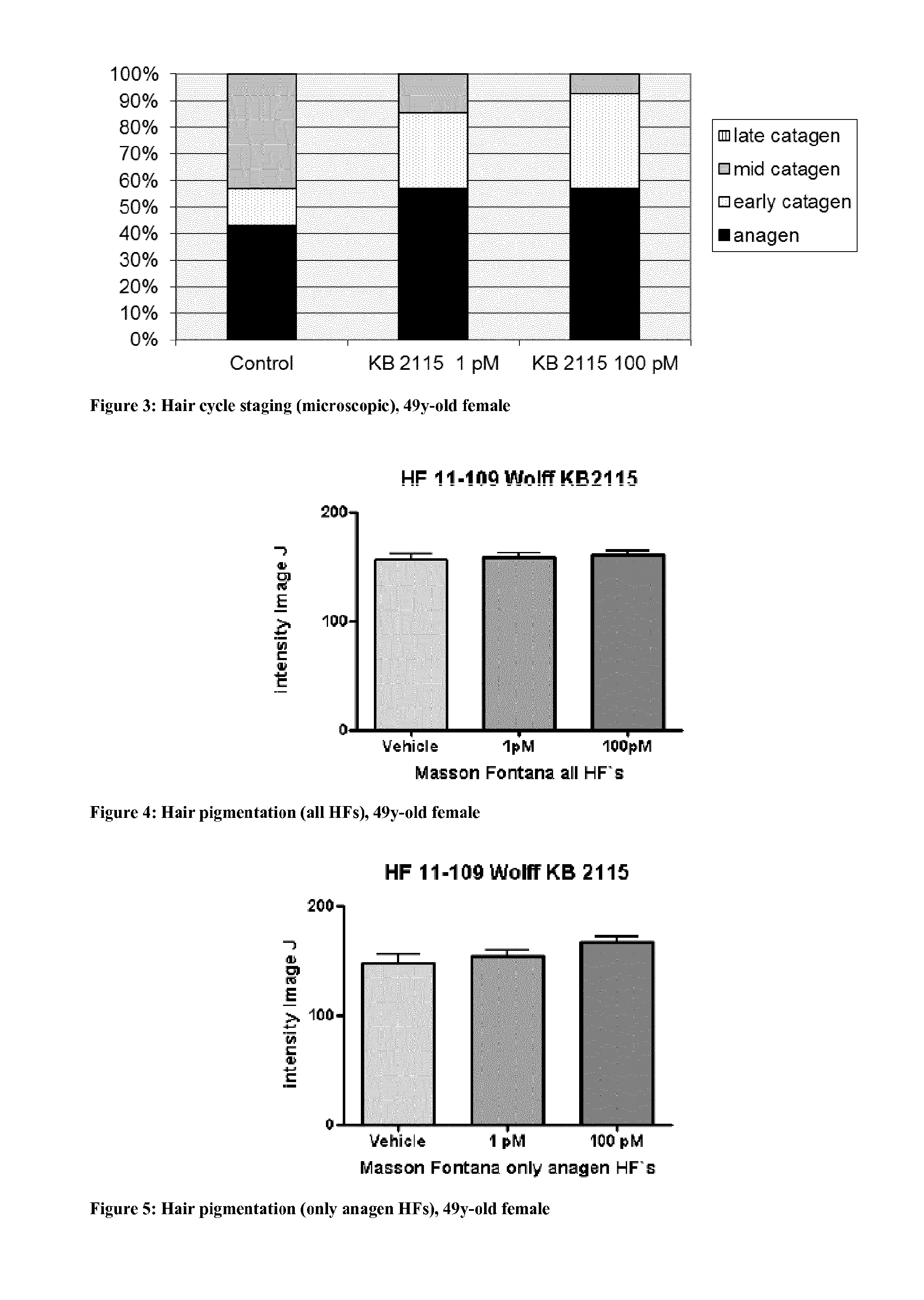Eprotirome for use in the prevention and/or treatment of hair disorders and compositions thereof