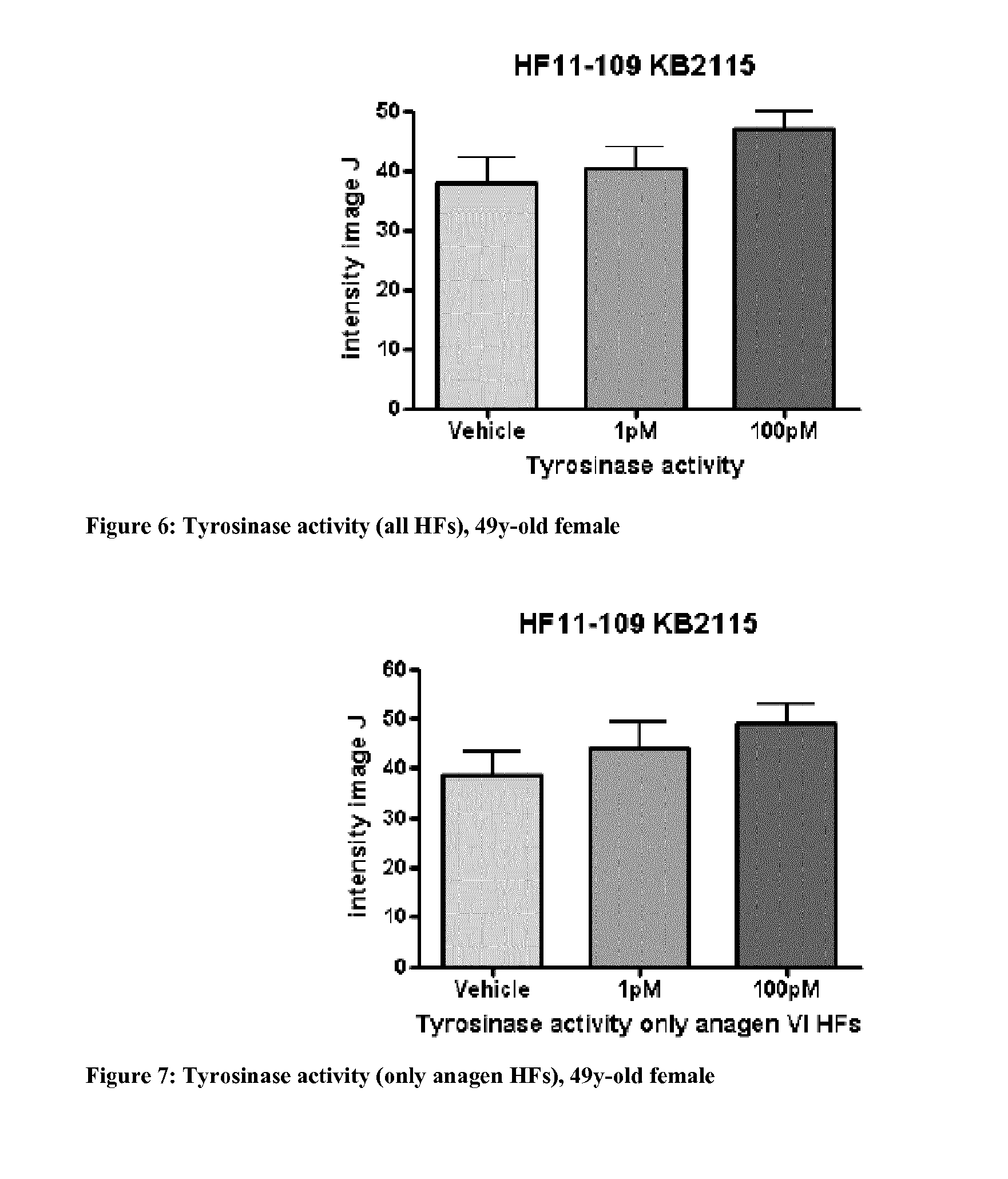 Eprotirome for use in the prevention and/or treatment of hair disorders and compositions thereof