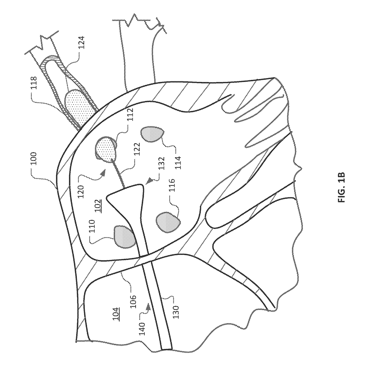 Devices and methods for ablation of tissue