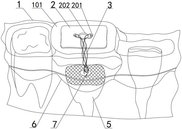 Tooth traction appliance