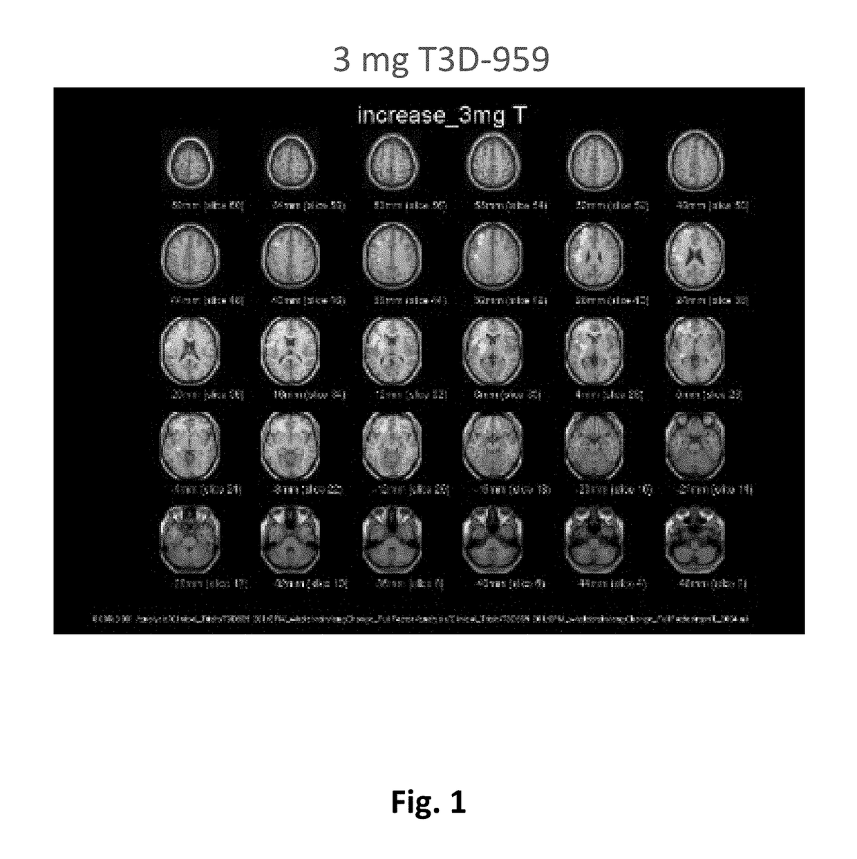 Methods of treating neurodegenerative diseases using indane acetic acid derivatives which penetrate the blood brain barrier