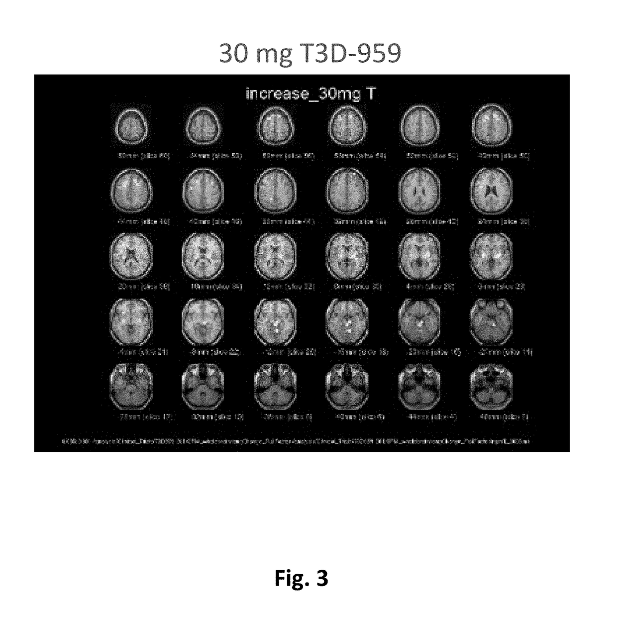 Methods of treating neurodegenerative diseases using indane acetic acid derivatives which penetrate the blood brain barrier