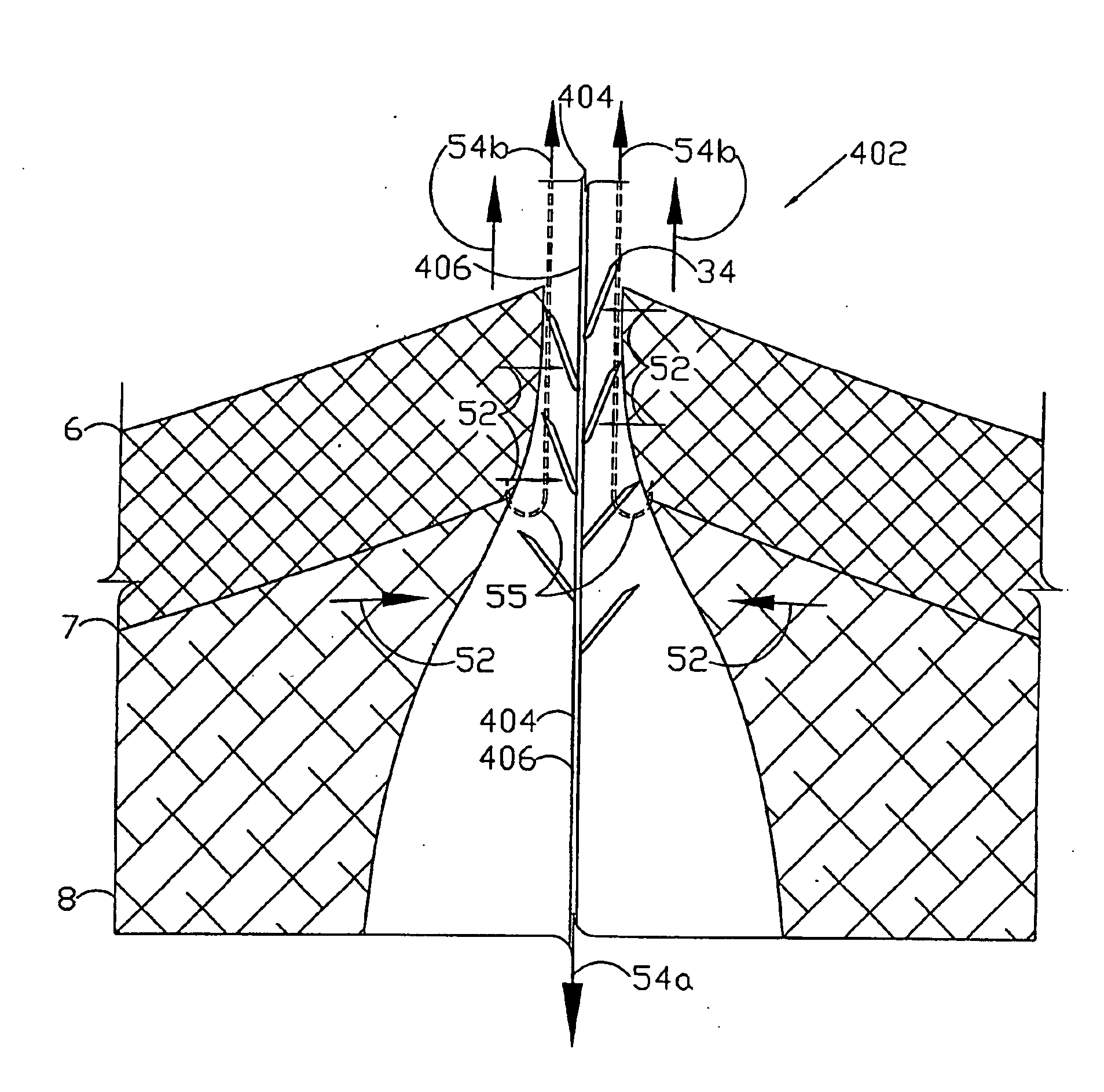 Internal and external medical closure screen systems and methods