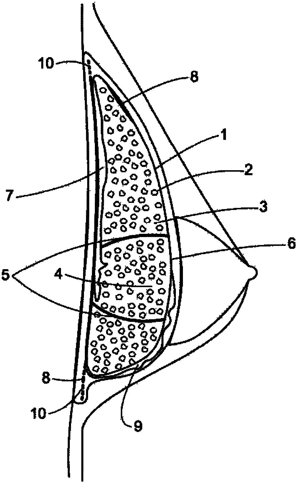 Silicon implant with expandable and/or interactive compartments, optionally coated with a ricinus communis and/or hydroxylapatite polyurethane foam, with attachment flaps or strings