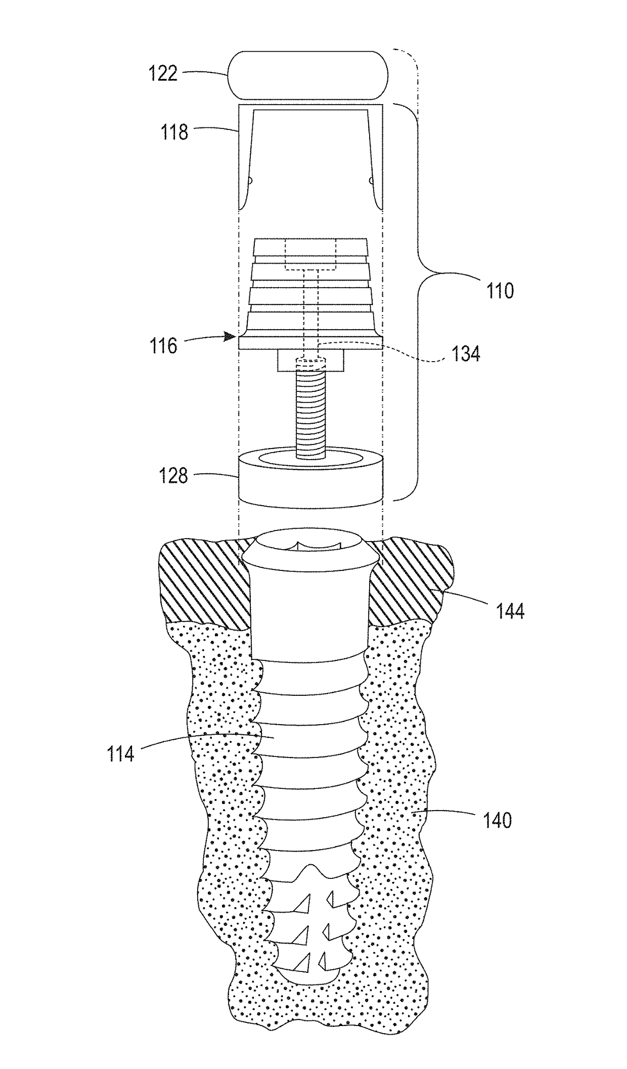 Digital full arch apparatus and method for immediate definitive dental prostheses