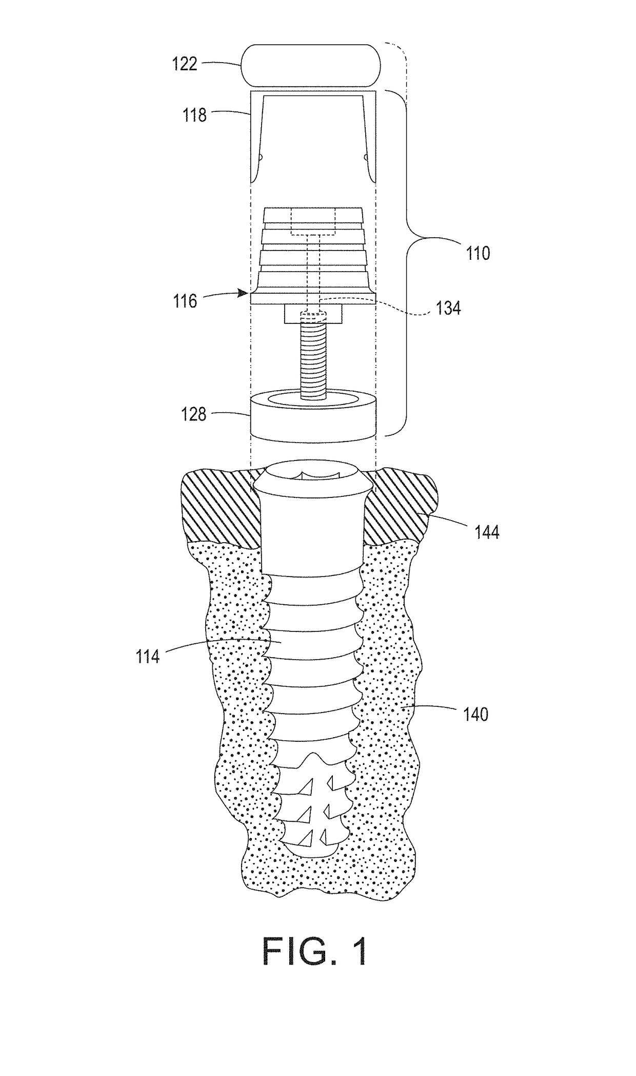 Digital full arch apparatus and method for immediate definitive dental prostheses