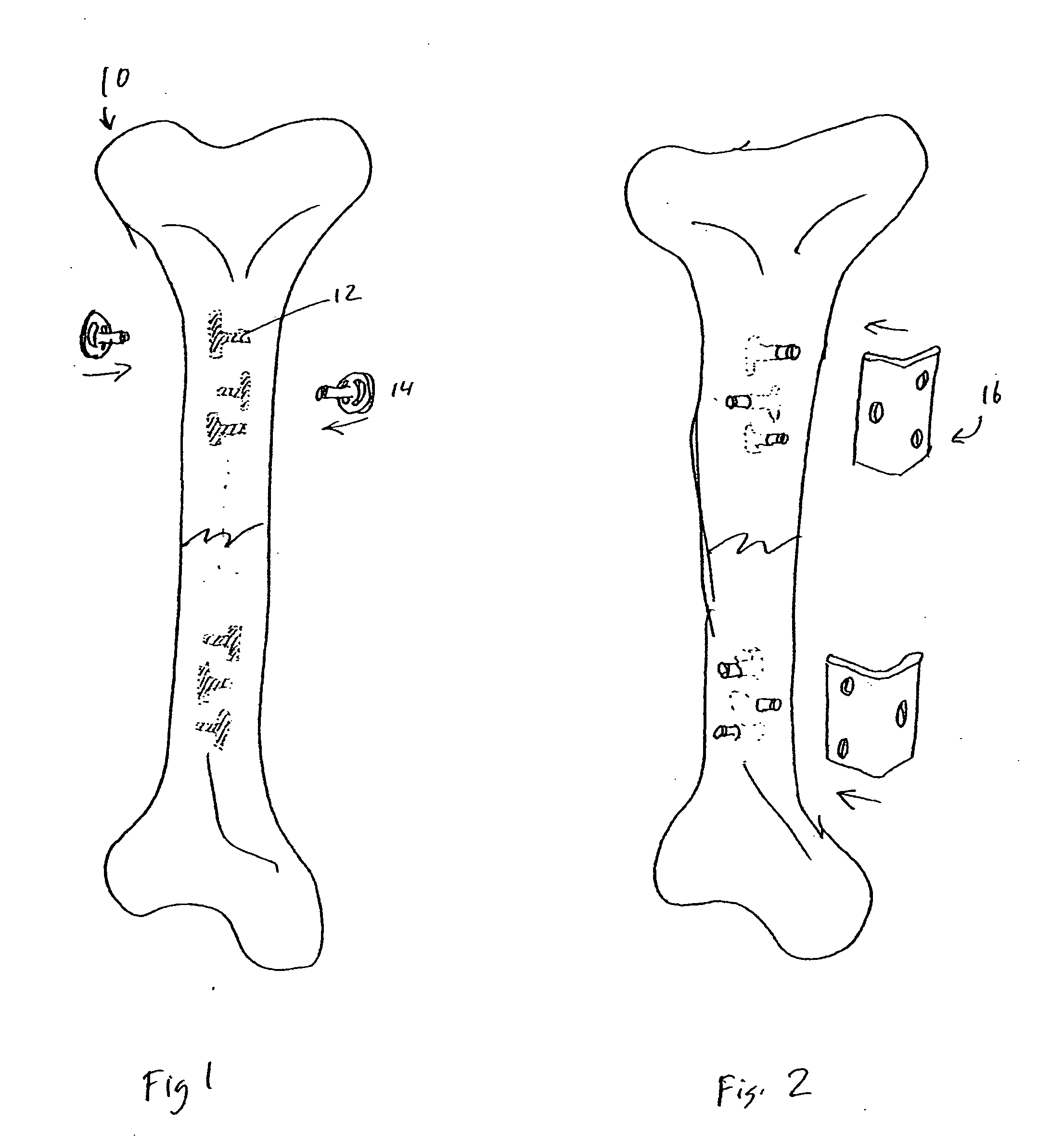 Lateral implant system and apparatus for reduction and reconstruction