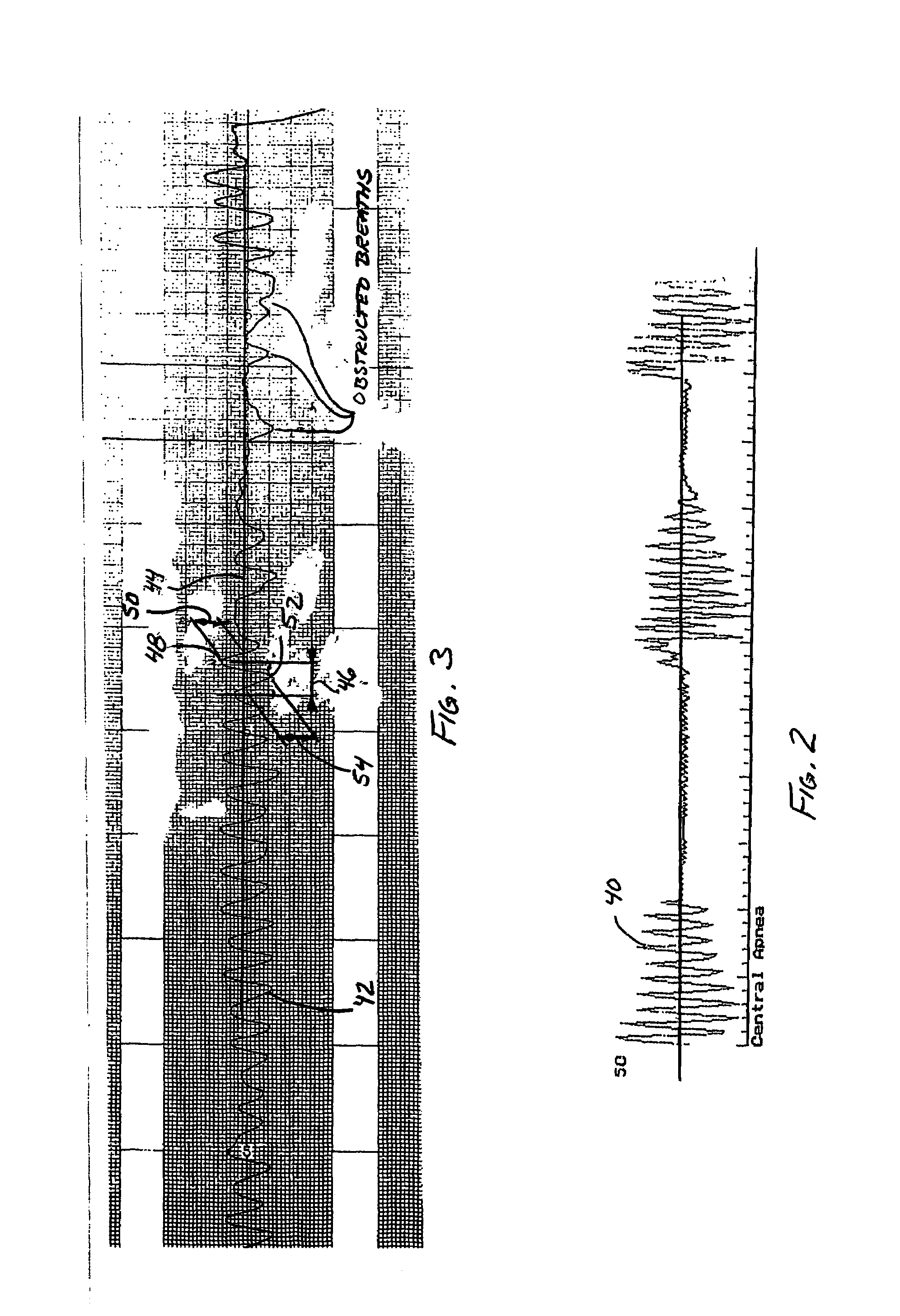Method for determining airway obstruction