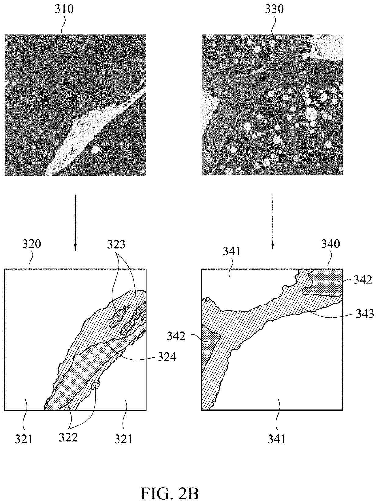 Computer aided method and electrical device for analyzing fibrosis