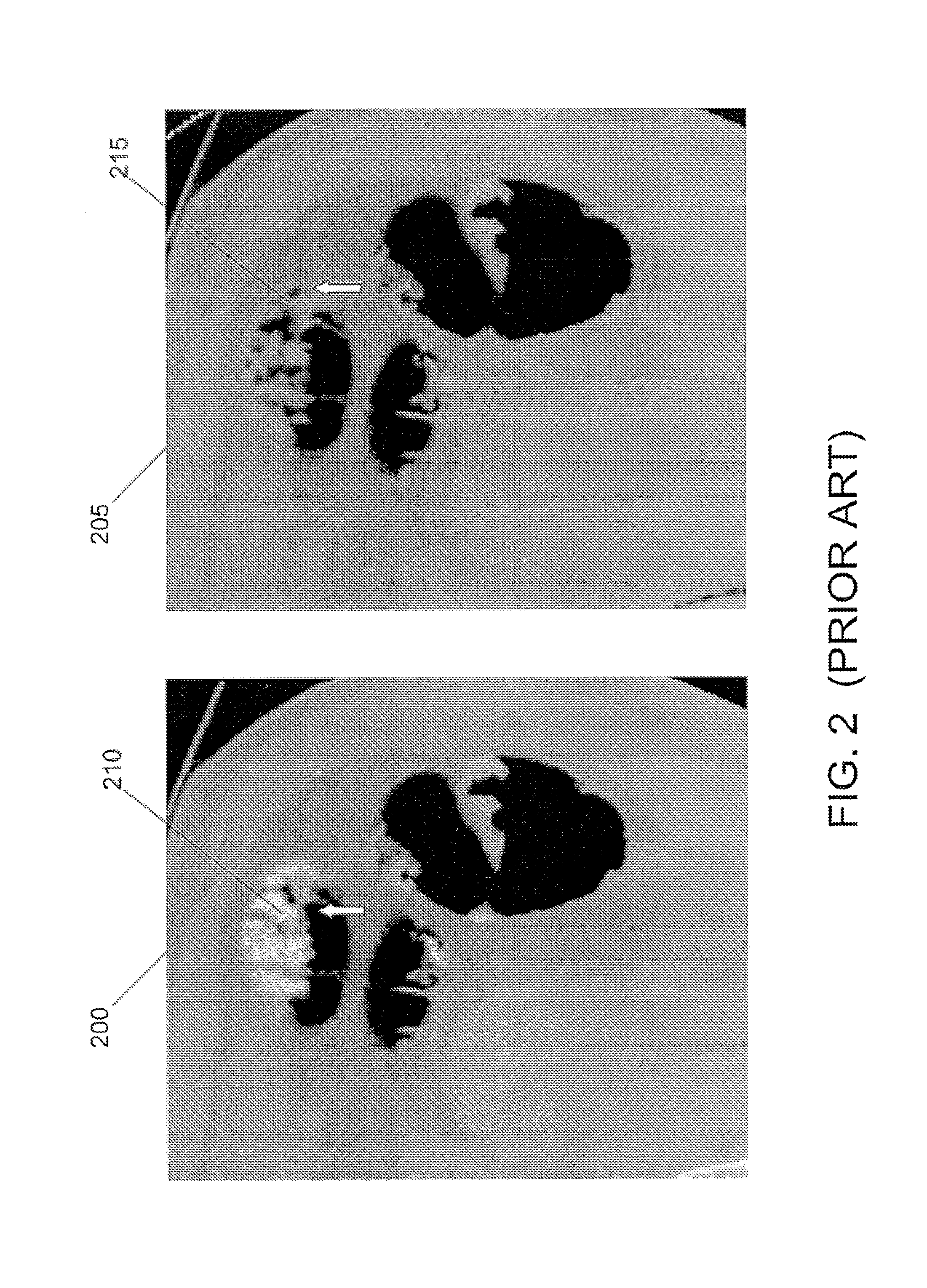 Structure-analysis system, method, software arrangement and computer-accessible medium for digital cleansing of computed tomography colonography images