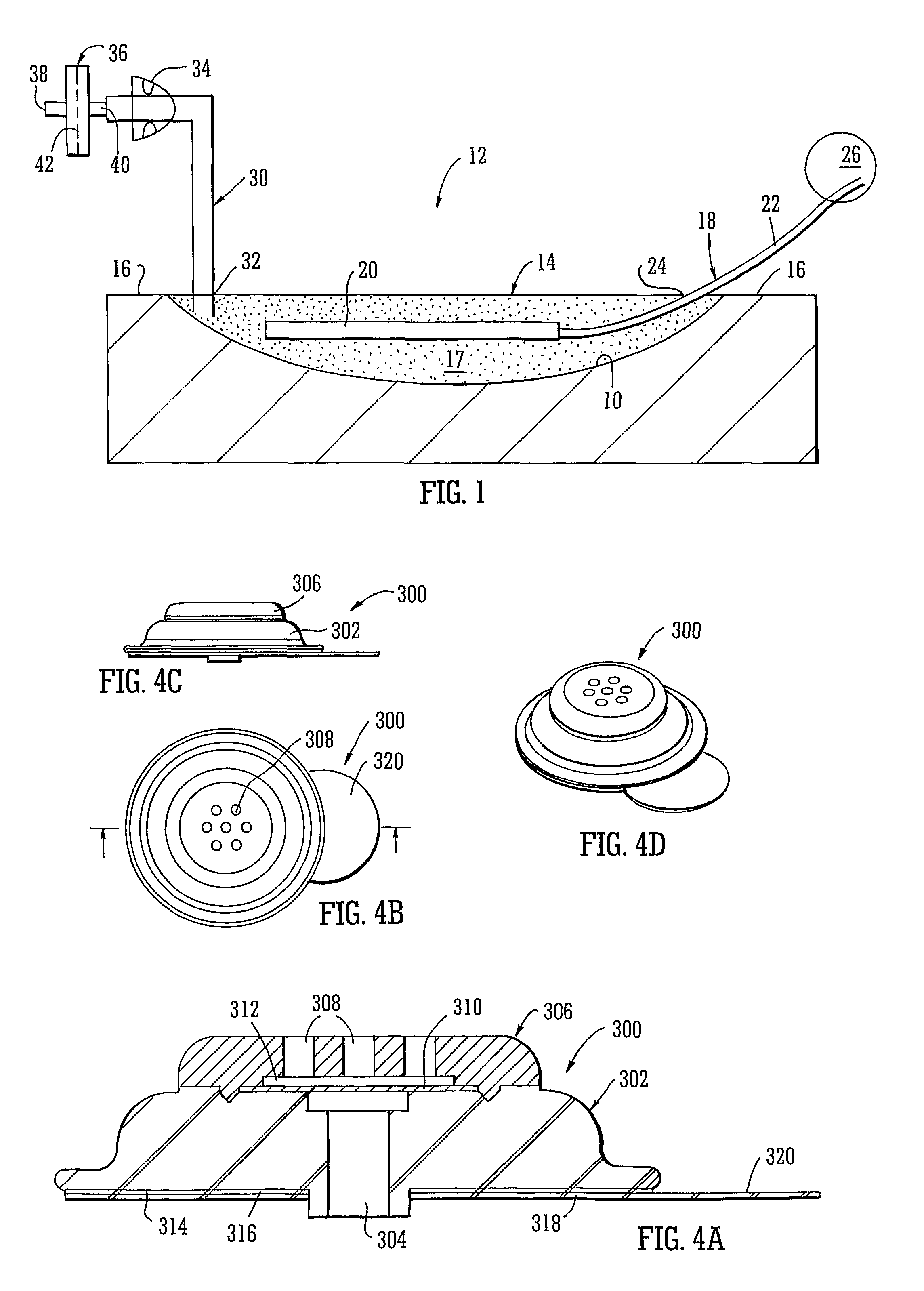 Apparatus for topical negative pressure therapy