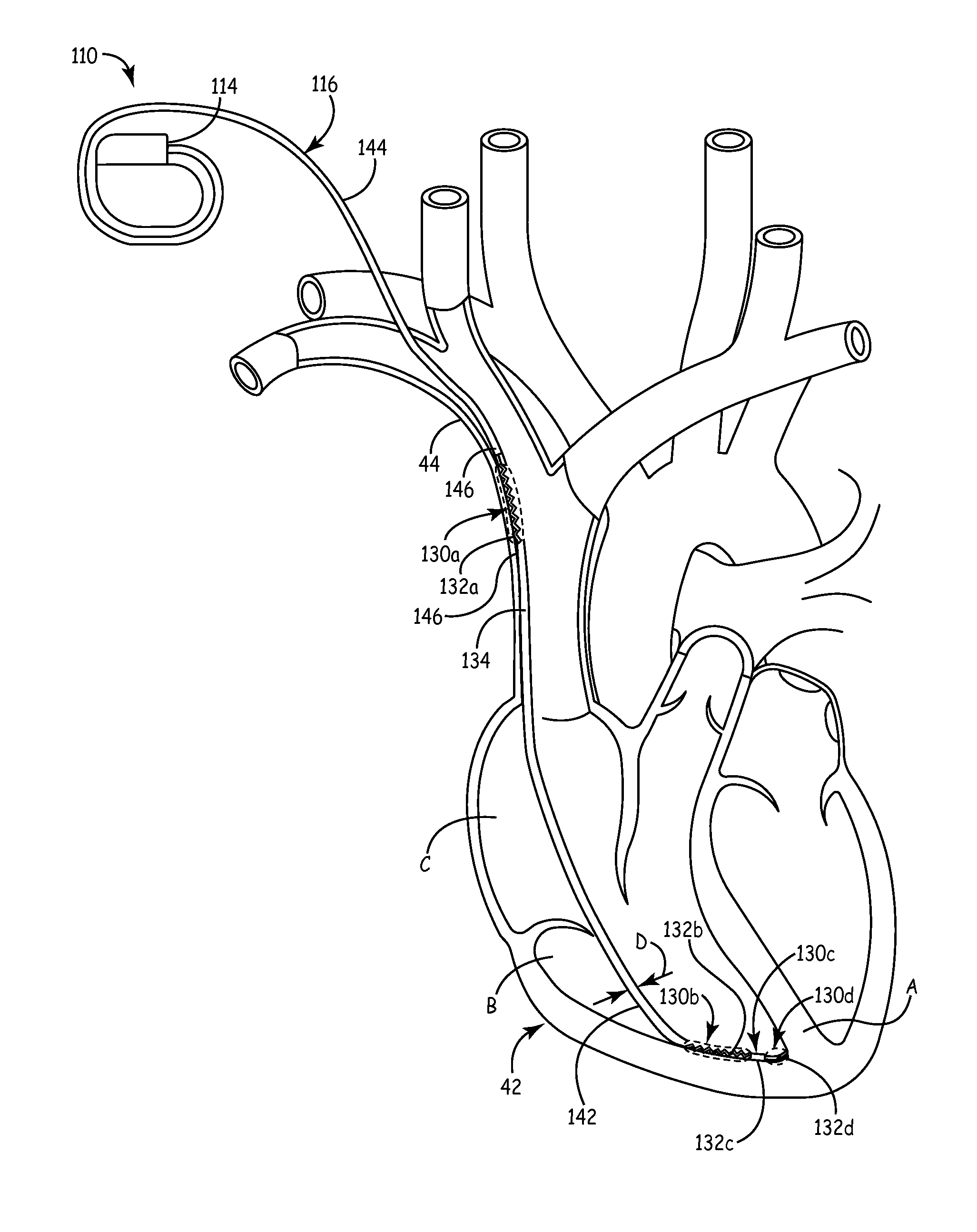 System and method for cardiac lead