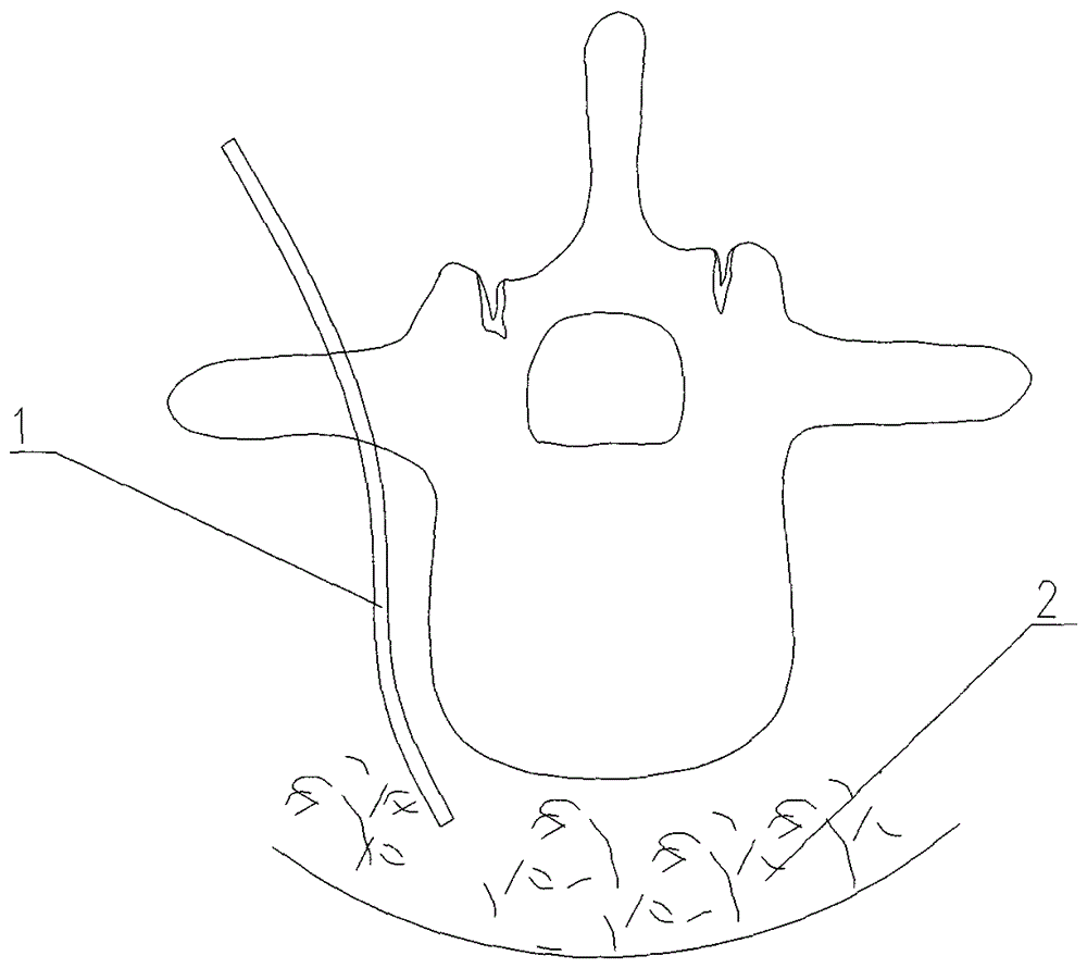 Pedicle screw and screw-rod system for the treatment of spinal tuberculosis with continuous irrigation and drainage