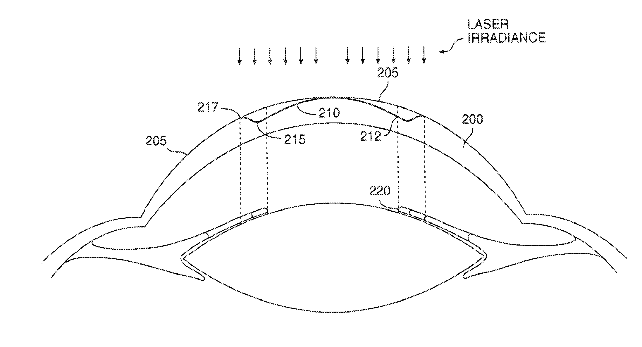 Method and Systems for Laser Treatment of Presbyopia Using Offset Imaging