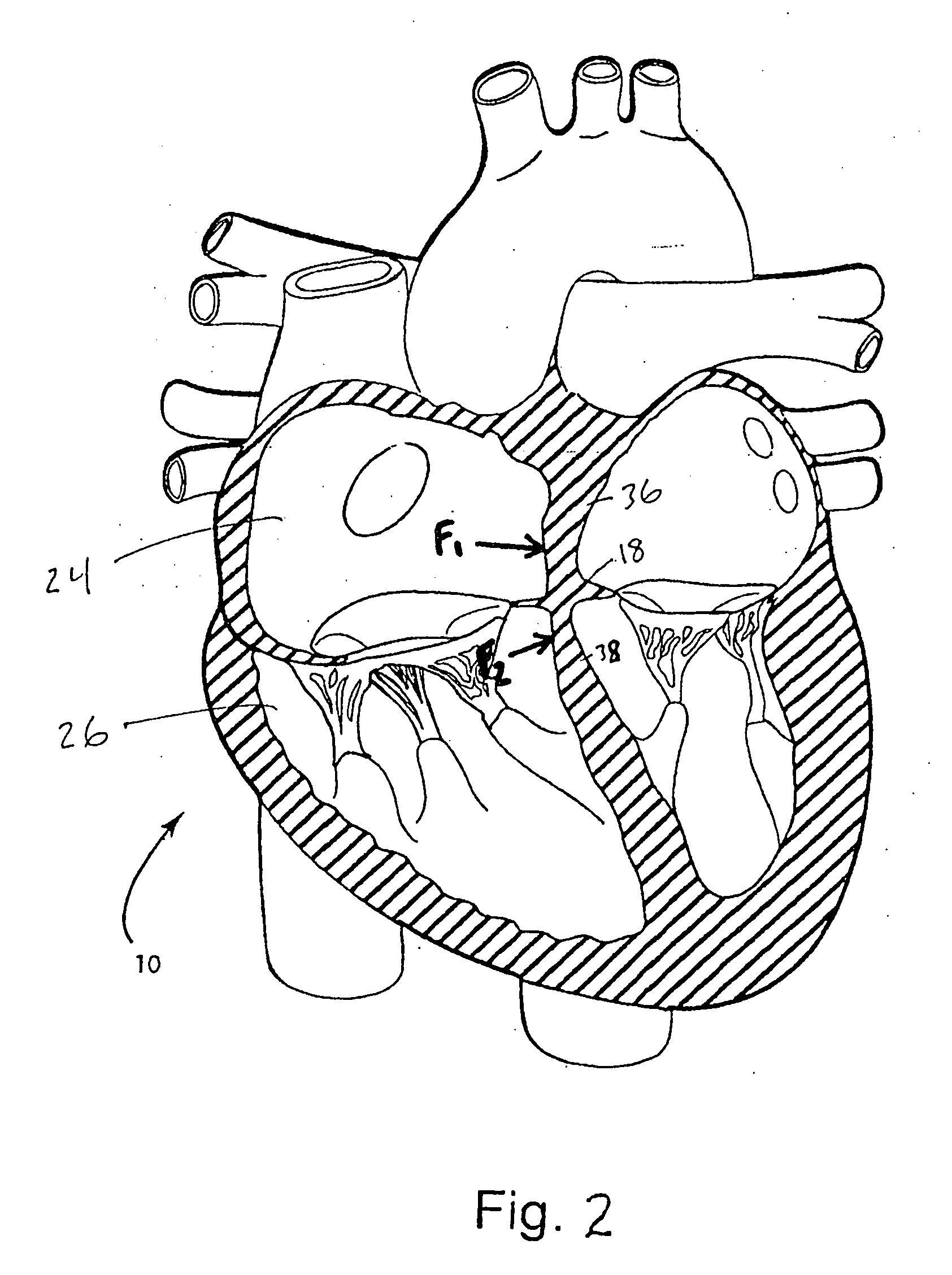 Device and method for reshaping mitral valve annulus
