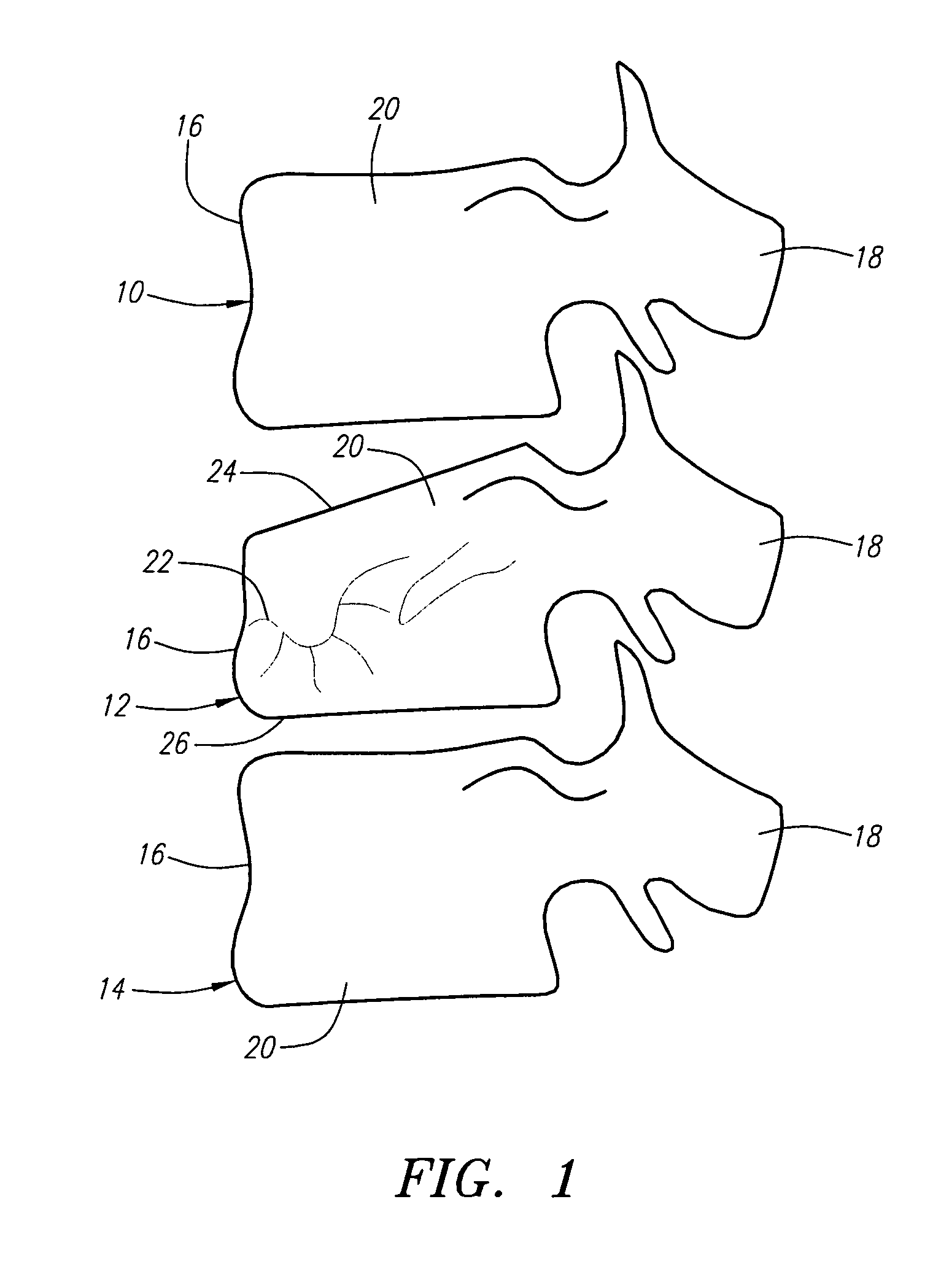 Methods for reducing bone compression fractures using wedges
