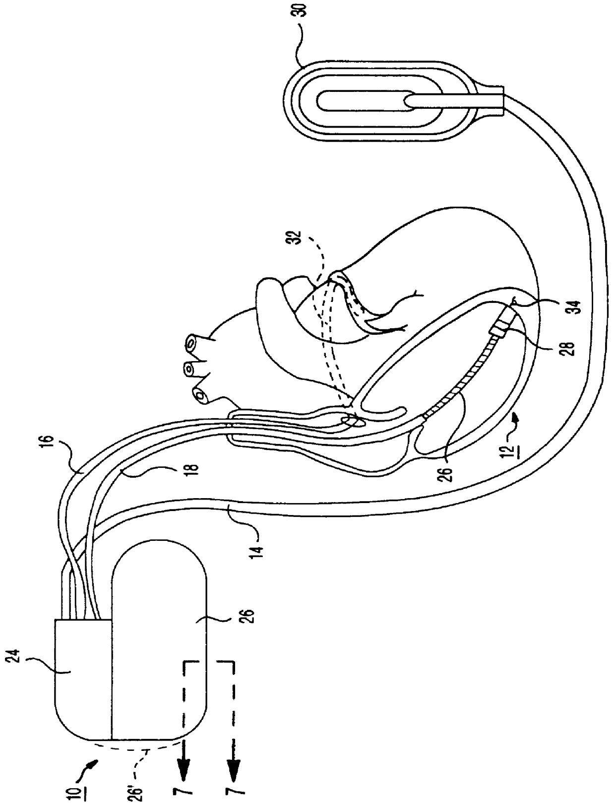 Implantable medical device incorporating distributed core, step-up transformer