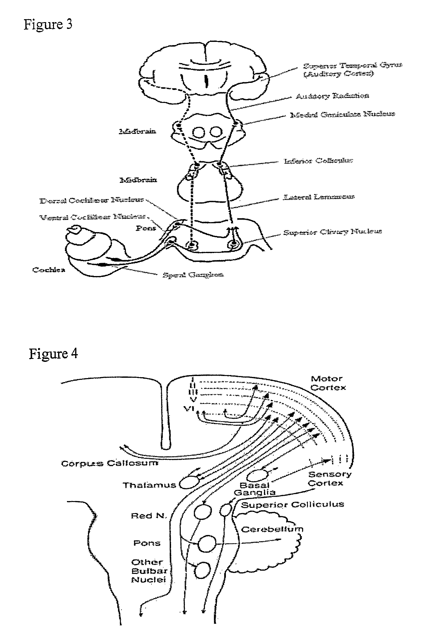 Method and Apparatus for Treatment of Tinnitus and Other Neurological Disorders by Brain Stimulation in the Inferior Colliculi and/or In Adjacent Areas