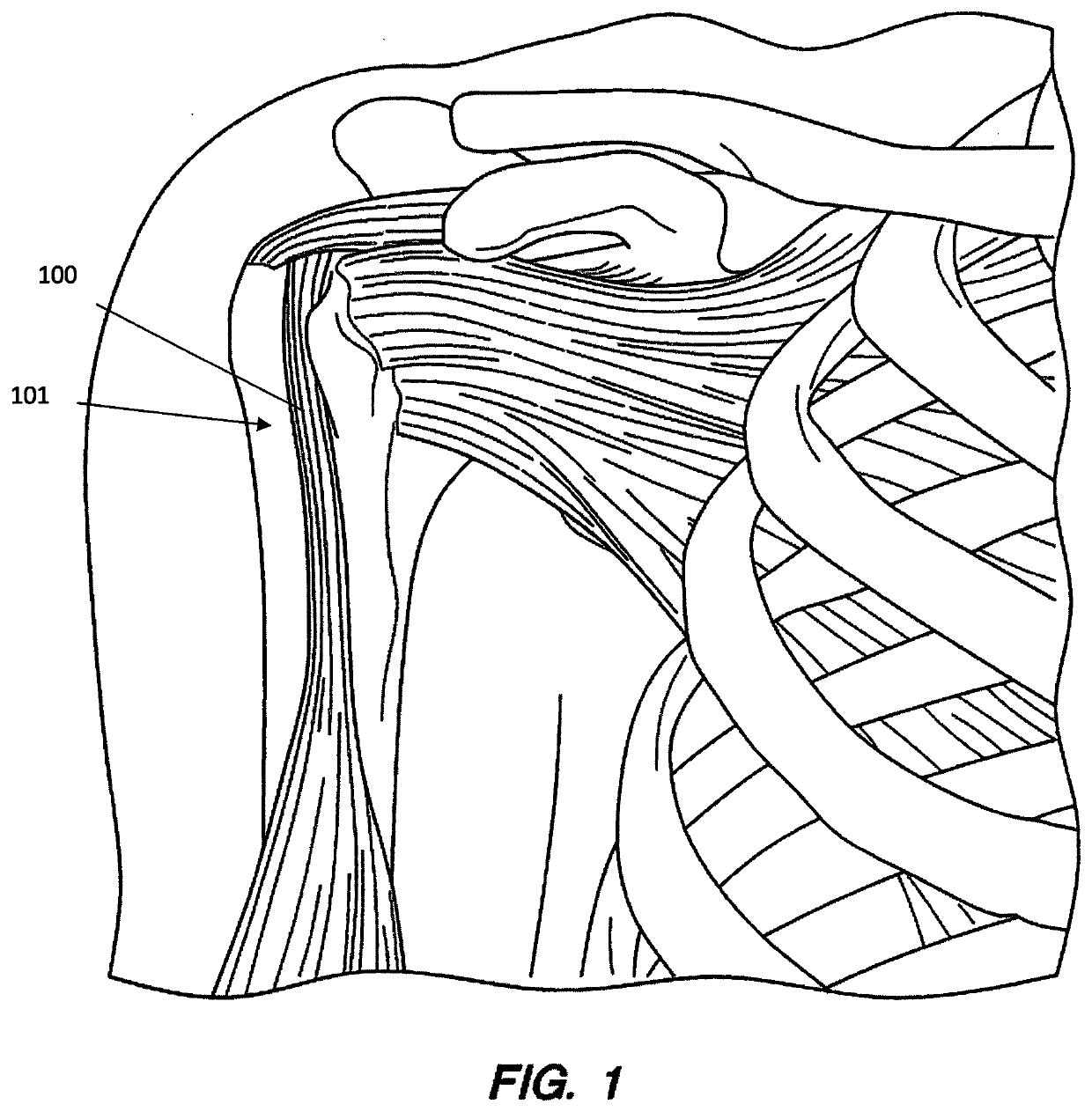 Direct soft tissue fixation implantable device and method of use