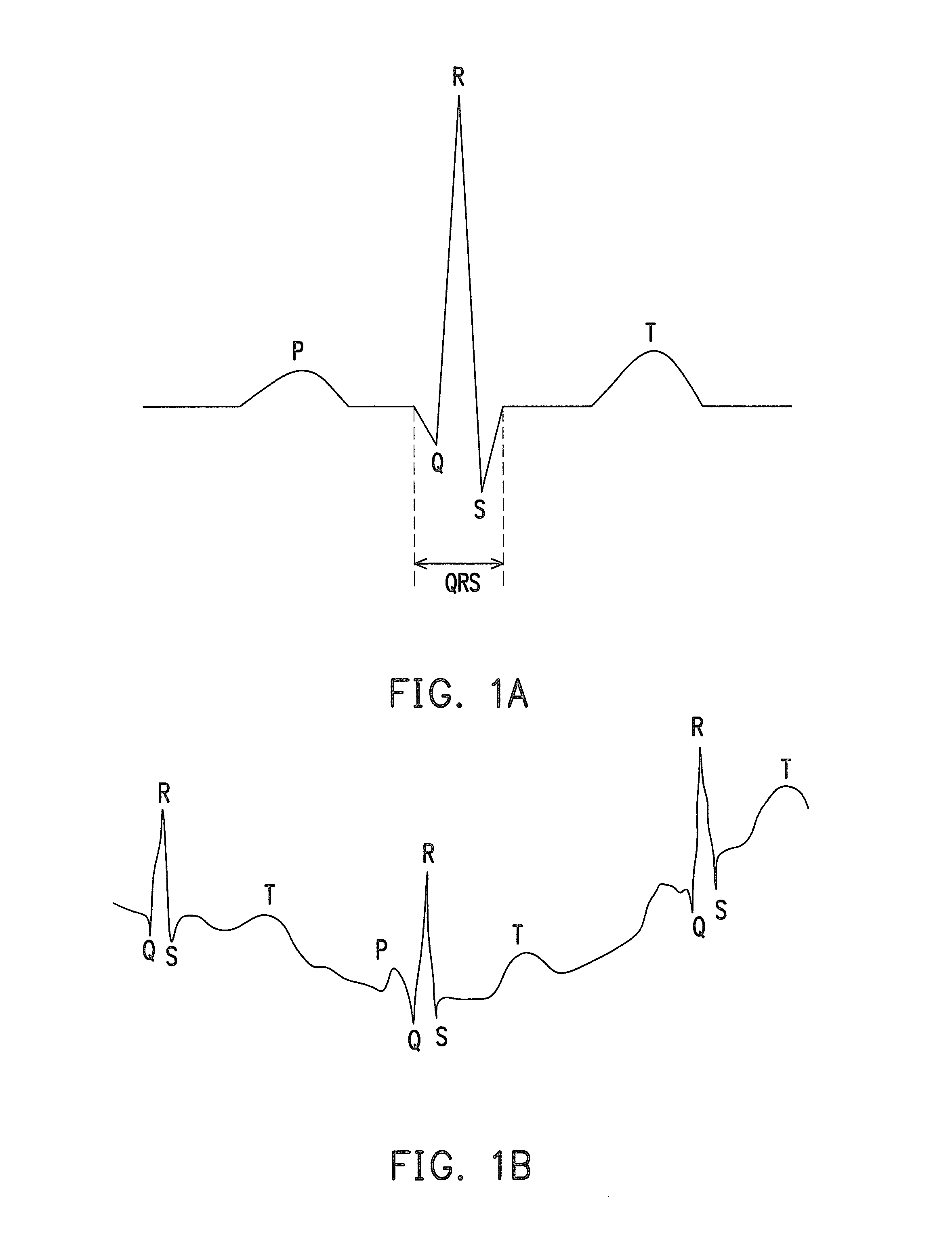 Method of eliminating noise from electrocardiography signal and electrocardiography signal sensing apparatus thereof