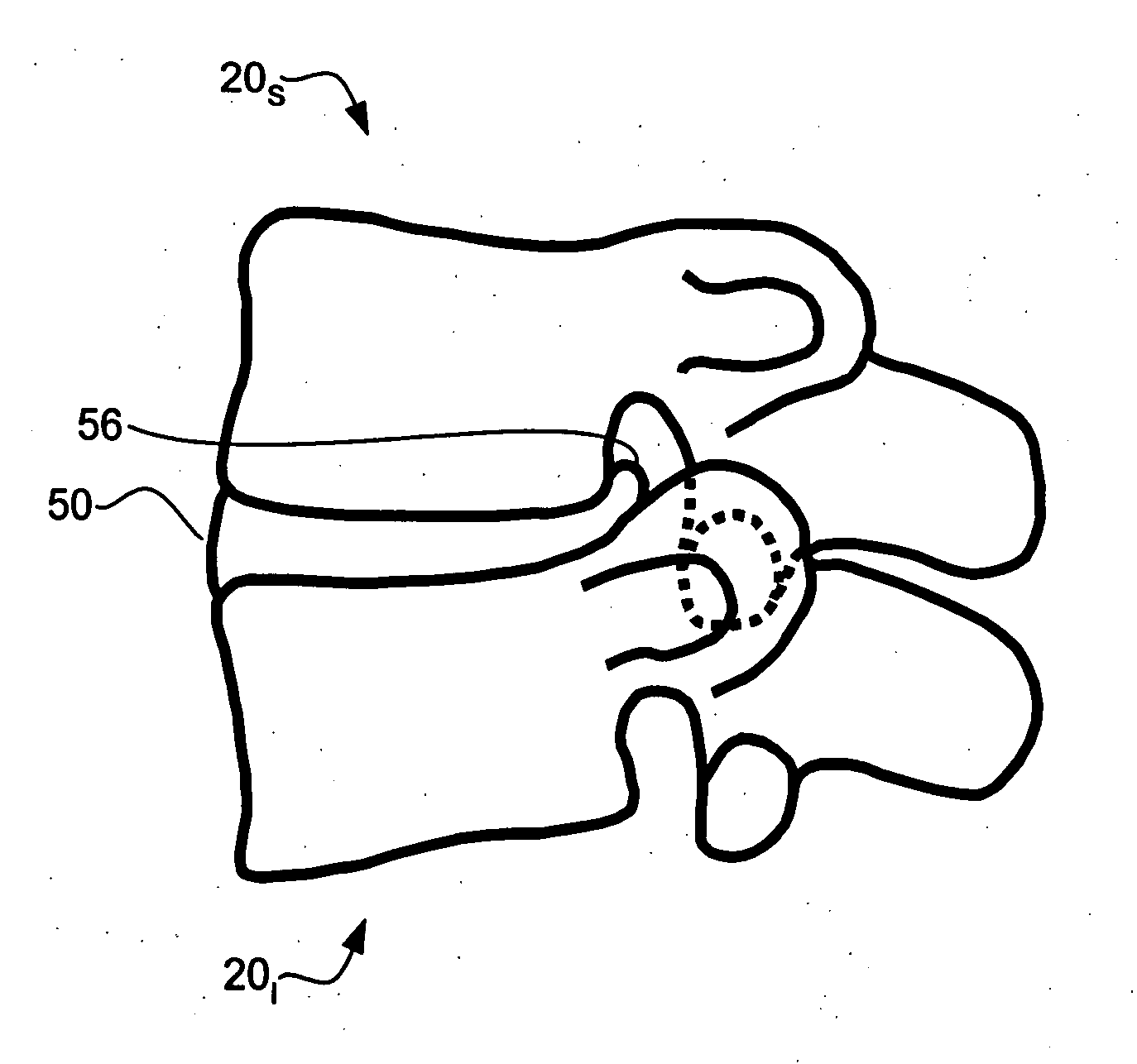 Devices and methods for the treatment of spinal disorders