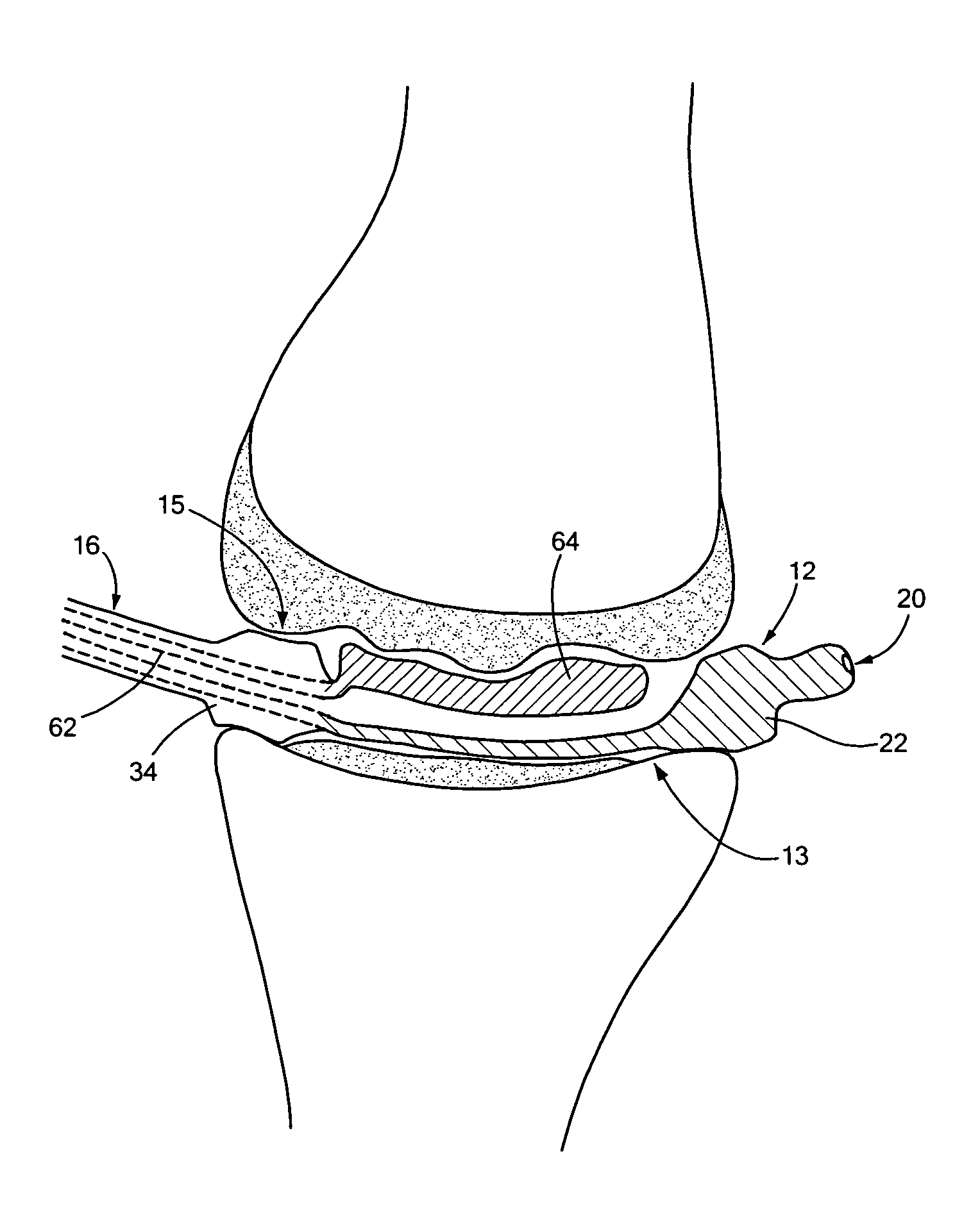 Joint arthroplasty devices formed in situ