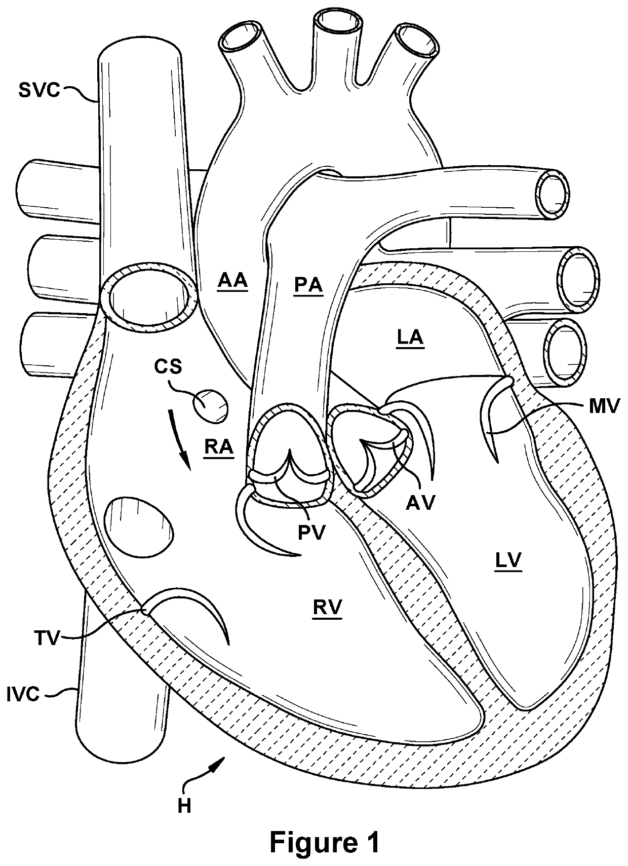 Native valve repair devices and procedures