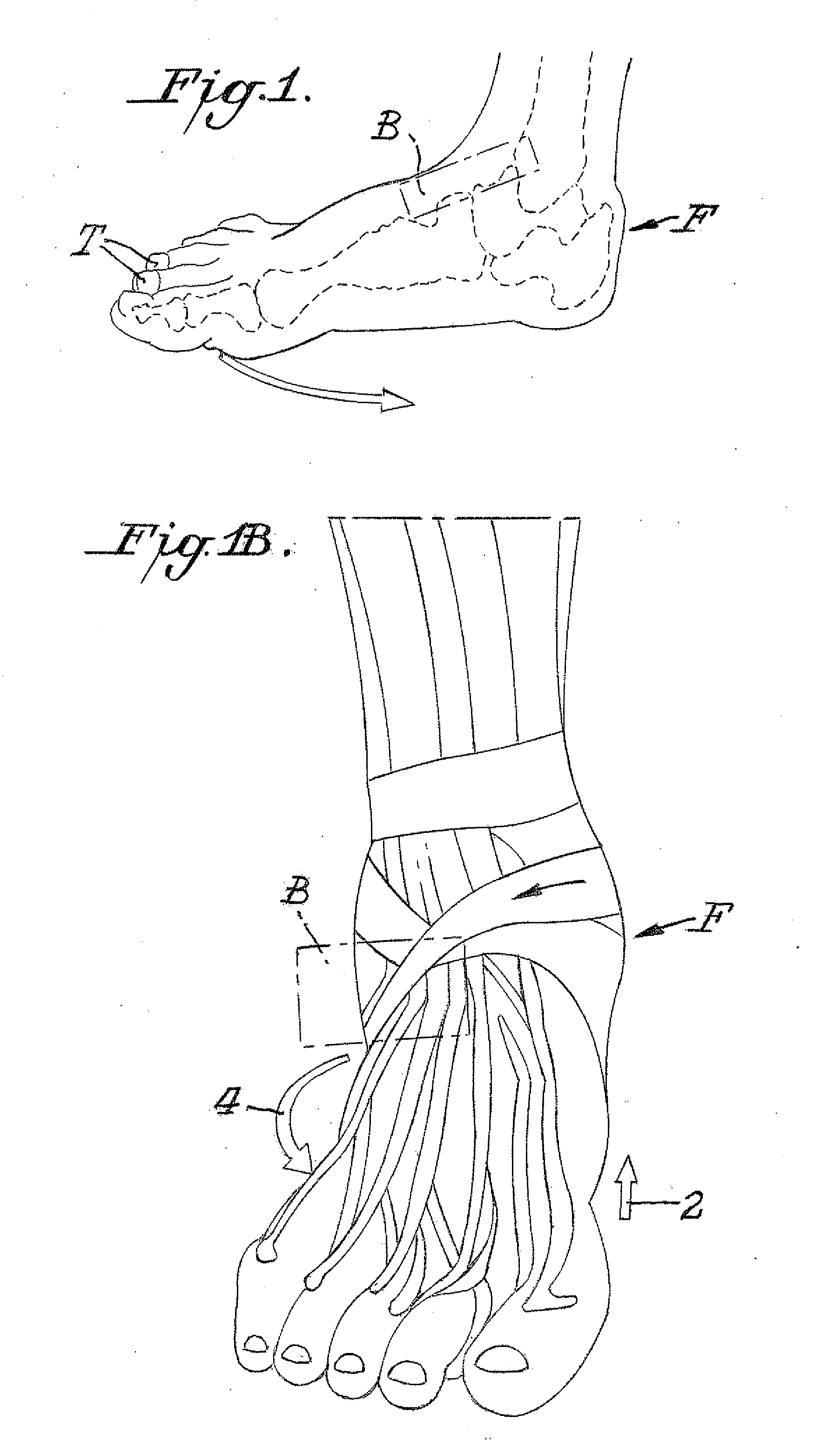 Ankle sprain reduction system