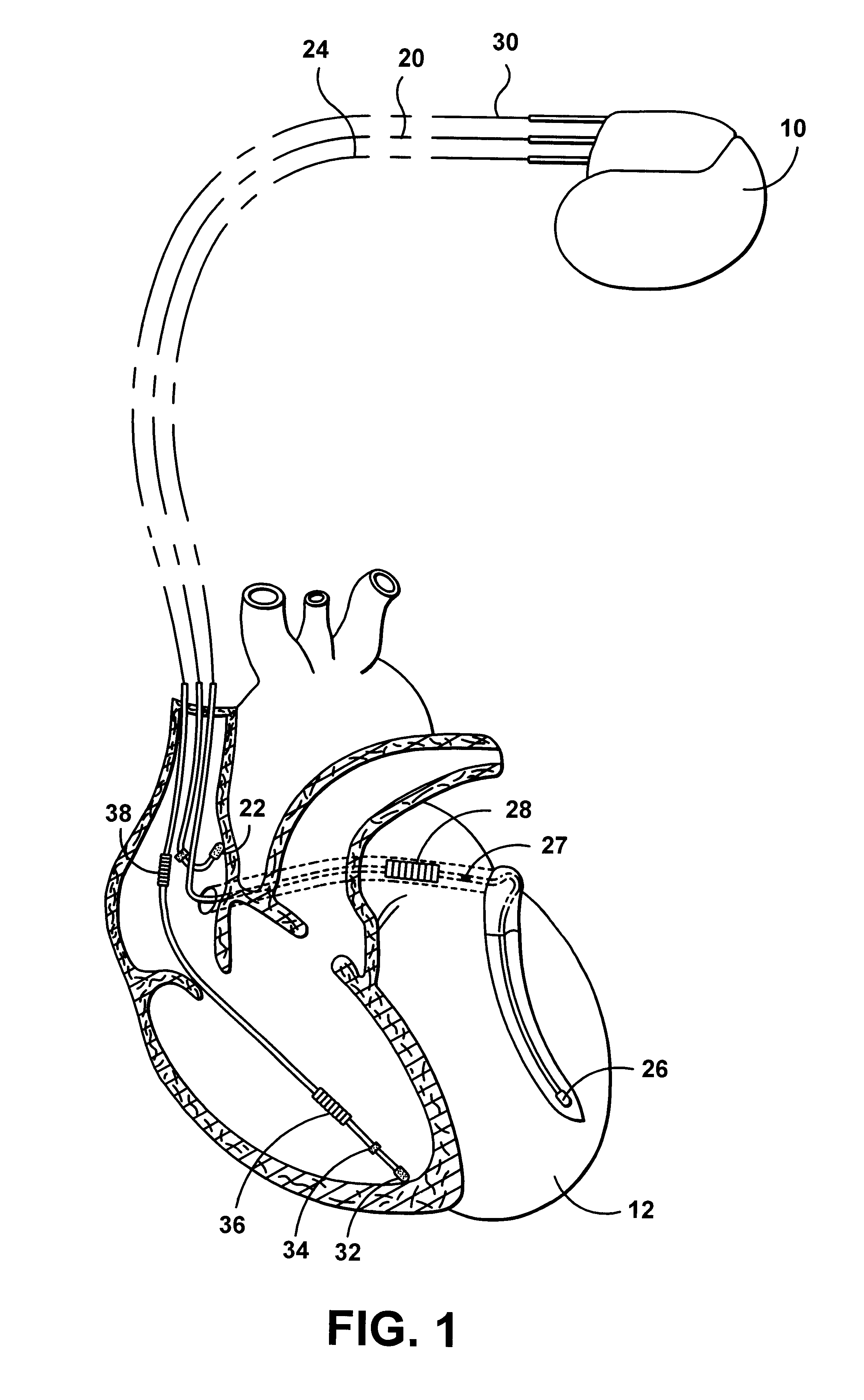 System and method for automatically selecting electrode polarity during sensing and stimulation