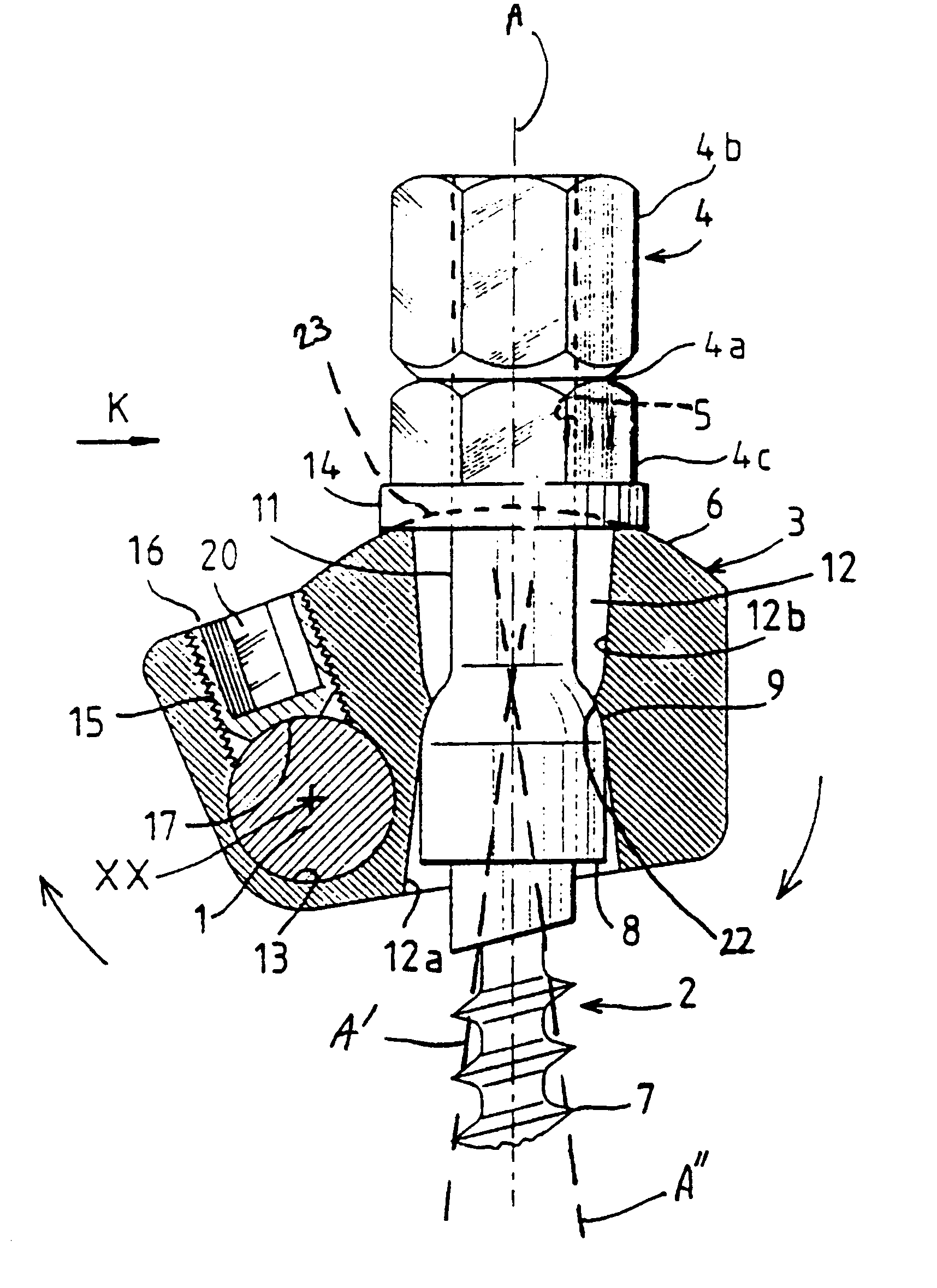 Spinal osteosynthesis device
