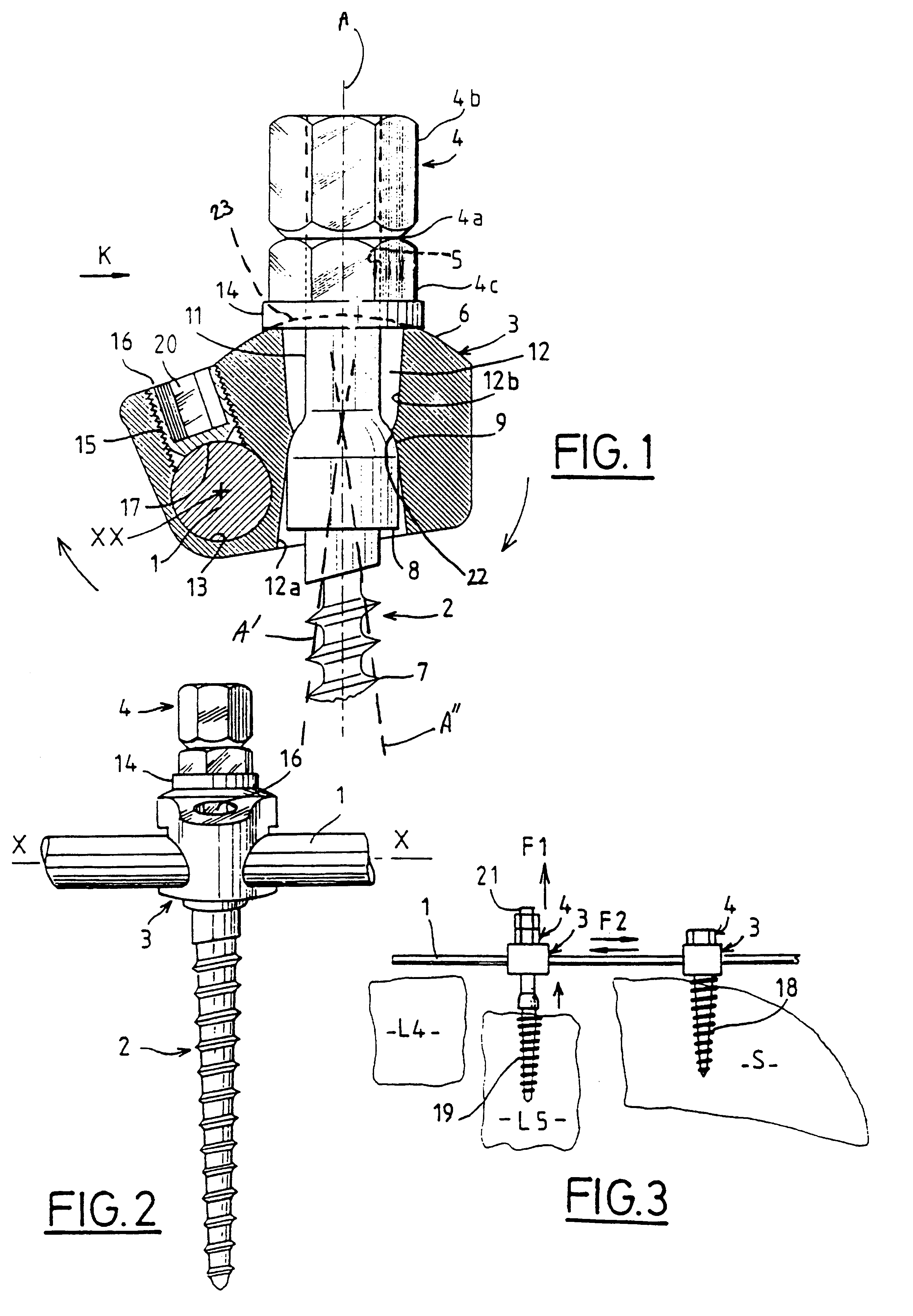 Spinal osteosynthesis device