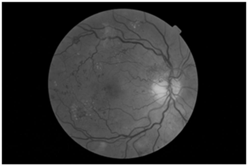 Retinal neovascularization detection method and imaging method for color fundus image