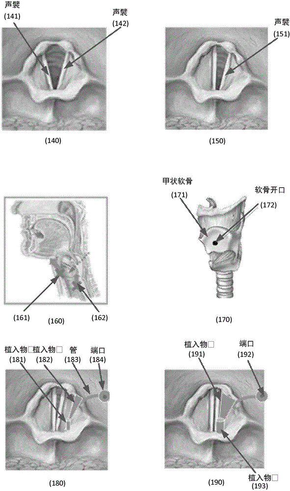 Methods and apparatus for treating glottis insufficiency