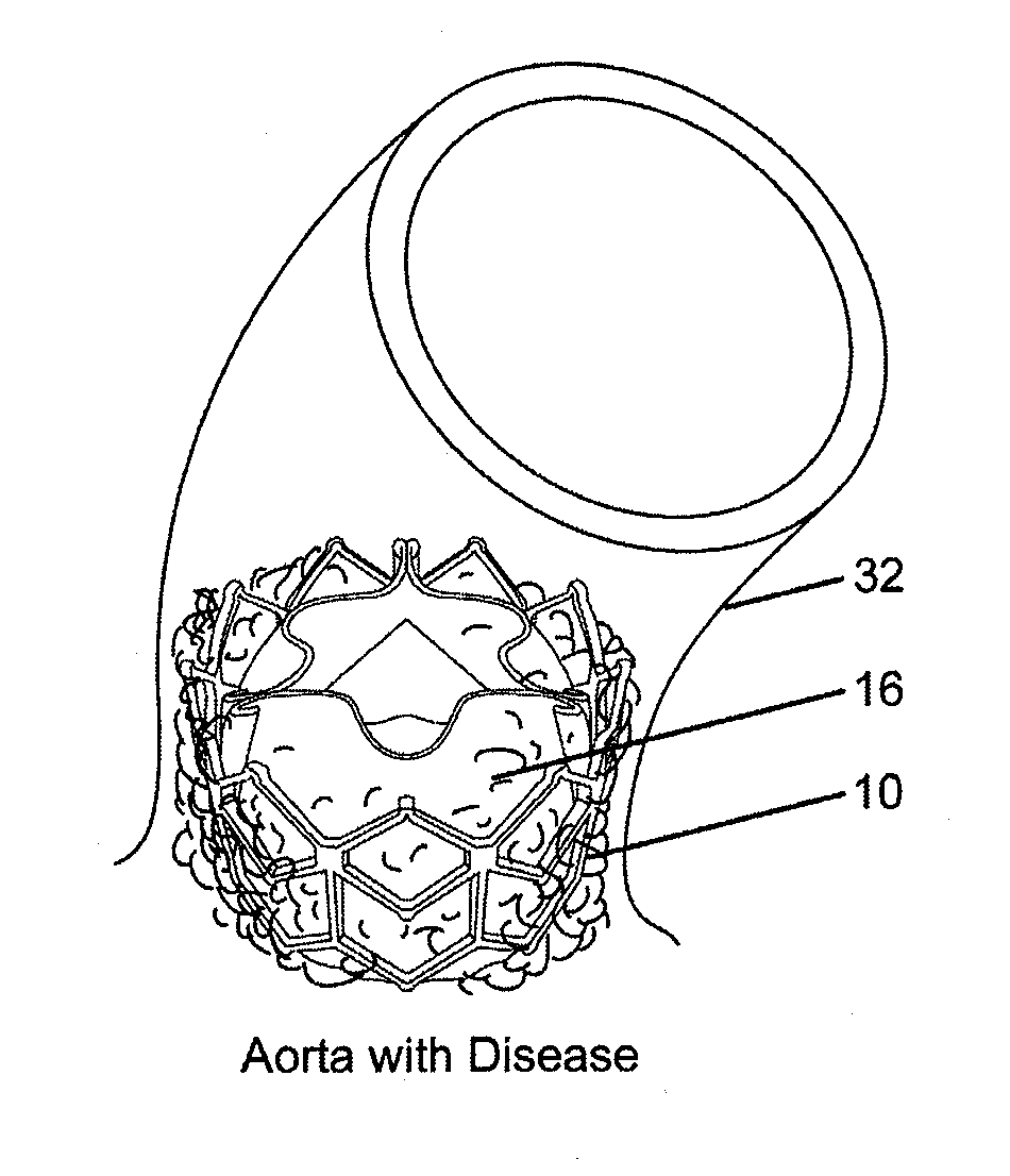 Methods for inhibiting stenosis, obstruction, or calcification of a stented heart valve