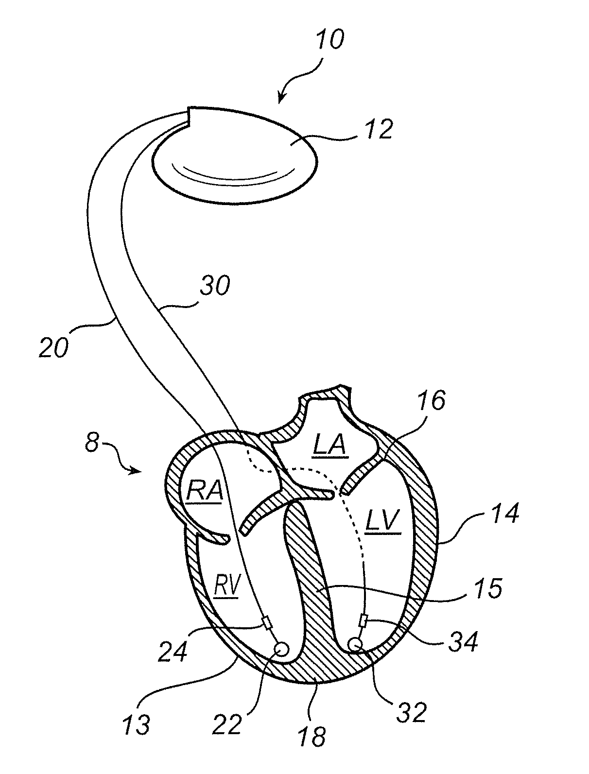 Implanted heart-stimulation device enabling charge balance after stimulation sequence