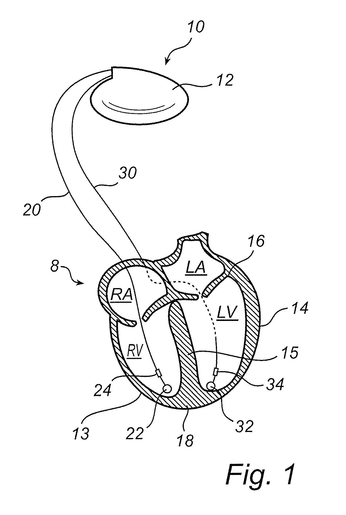 Implanted heart-stimulation device enabling charge balance after stimulation sequence