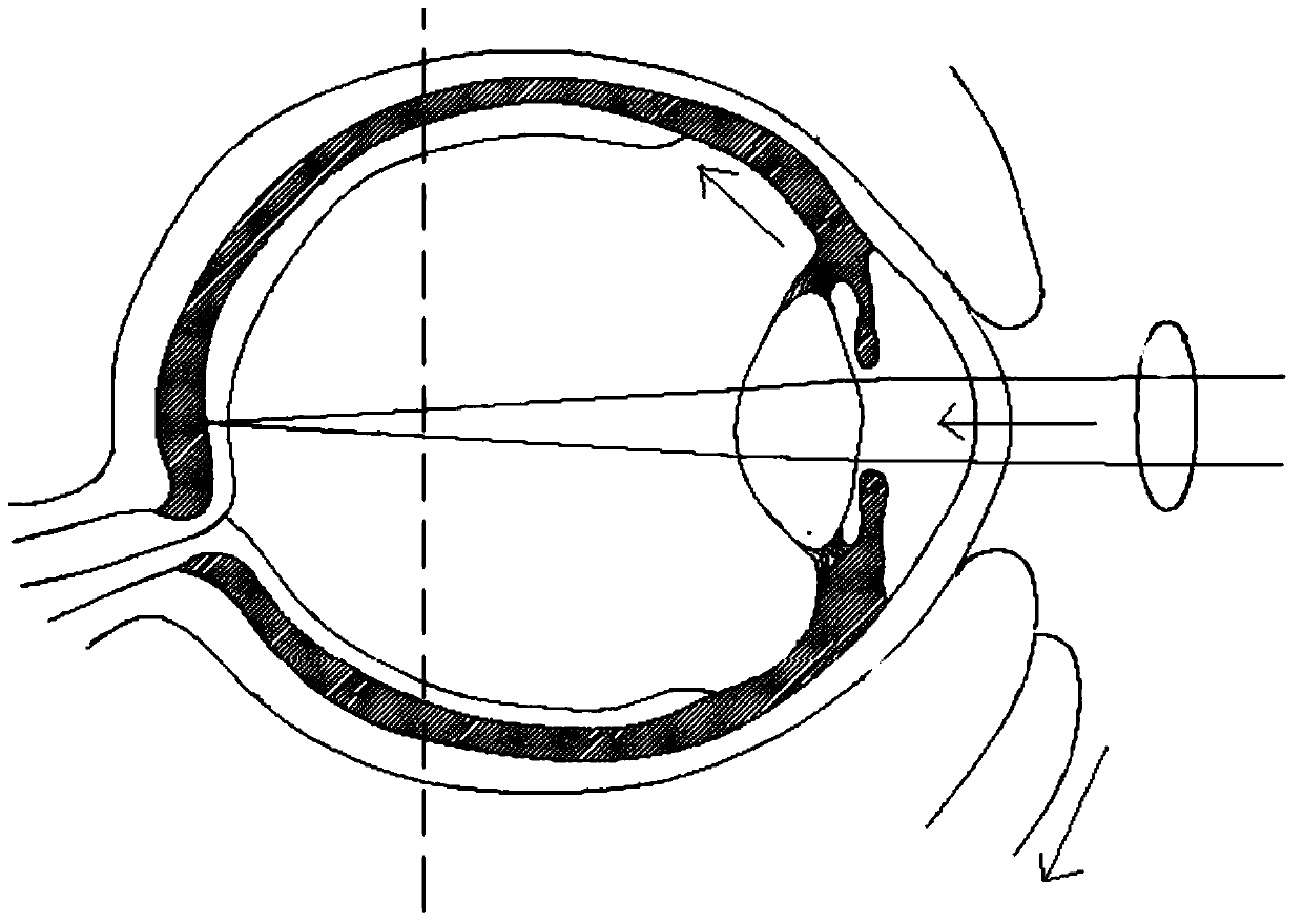 Ciliary muscle intraocular pressure focus correction method and device