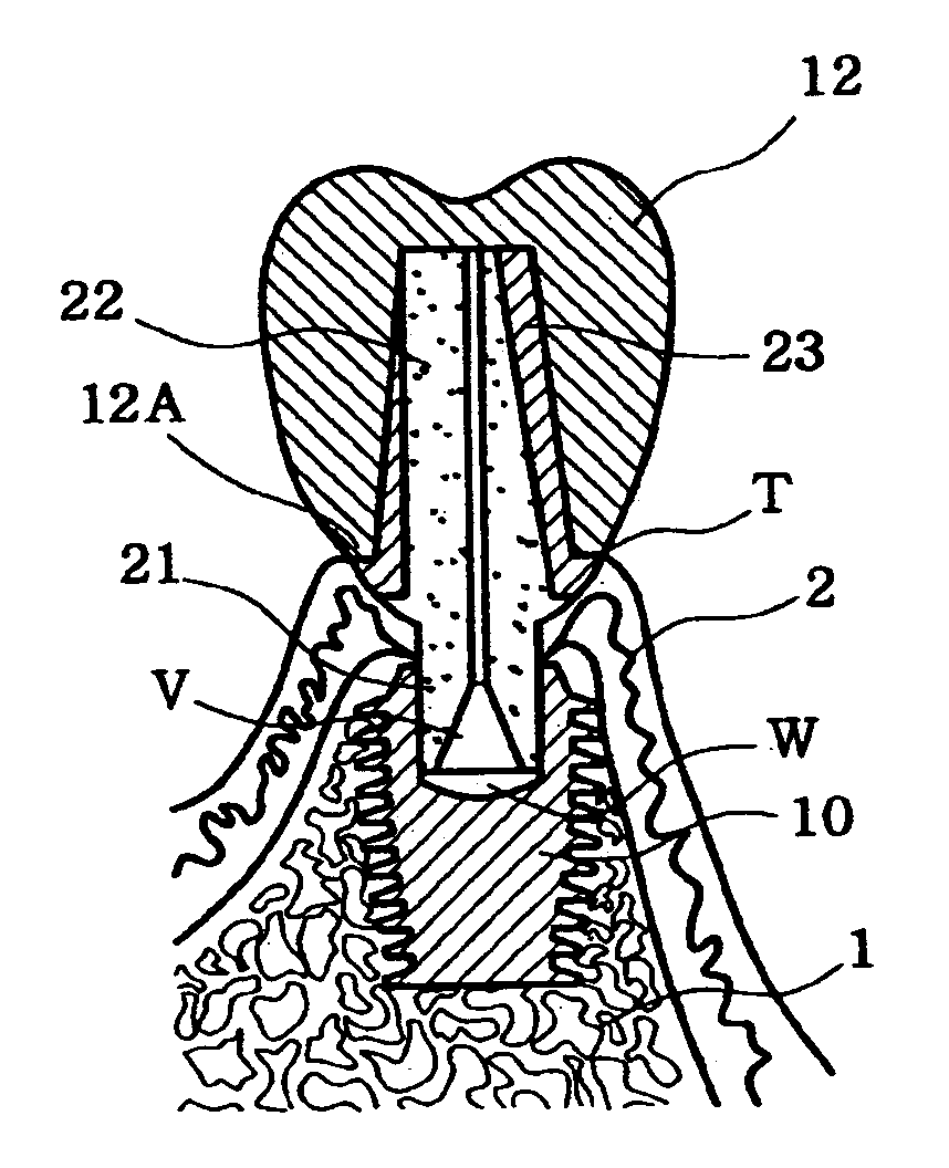 Locking-taper abutment for dental implants