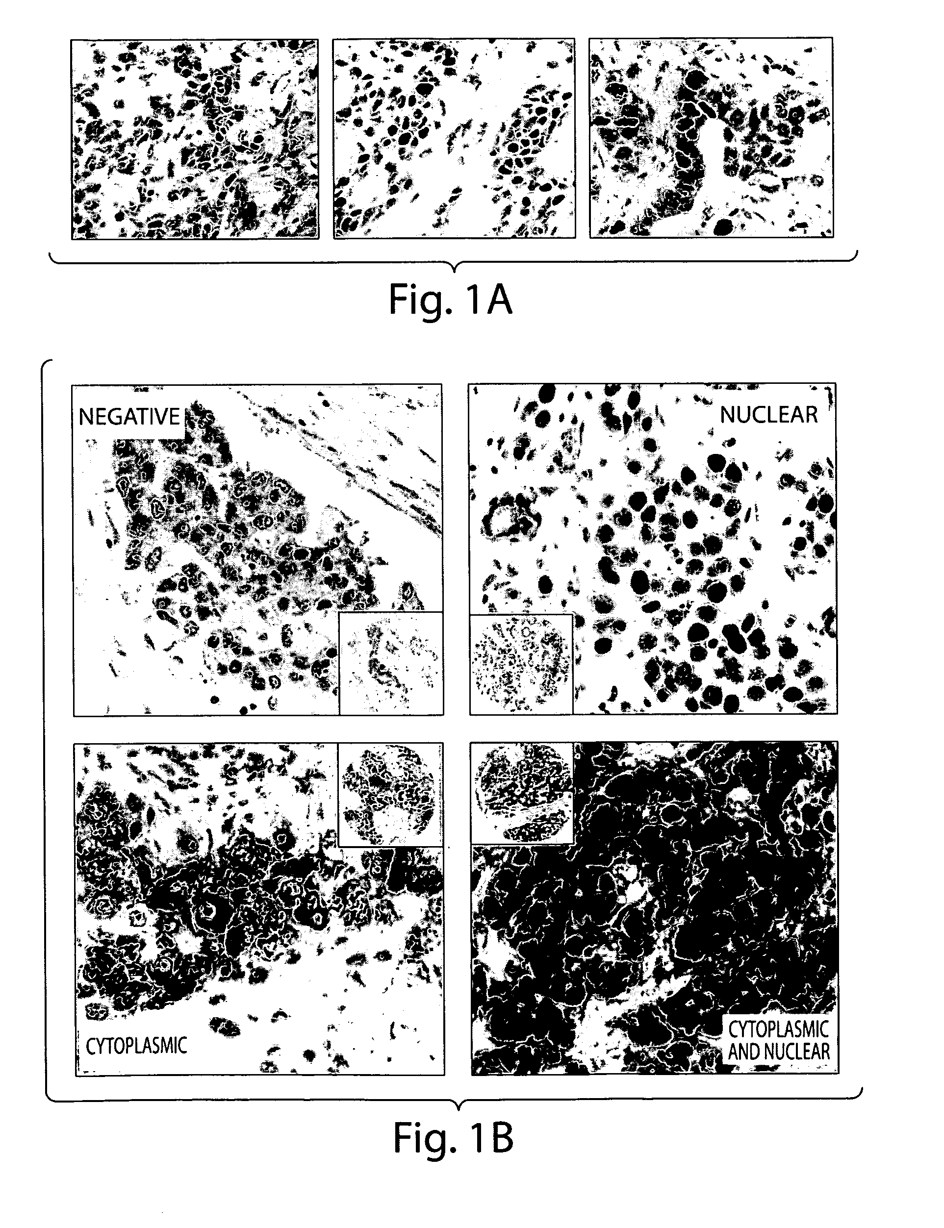 DNA Repair Proteins Associated With Triple Negative Breast Cancers and Methods of Use Thereof