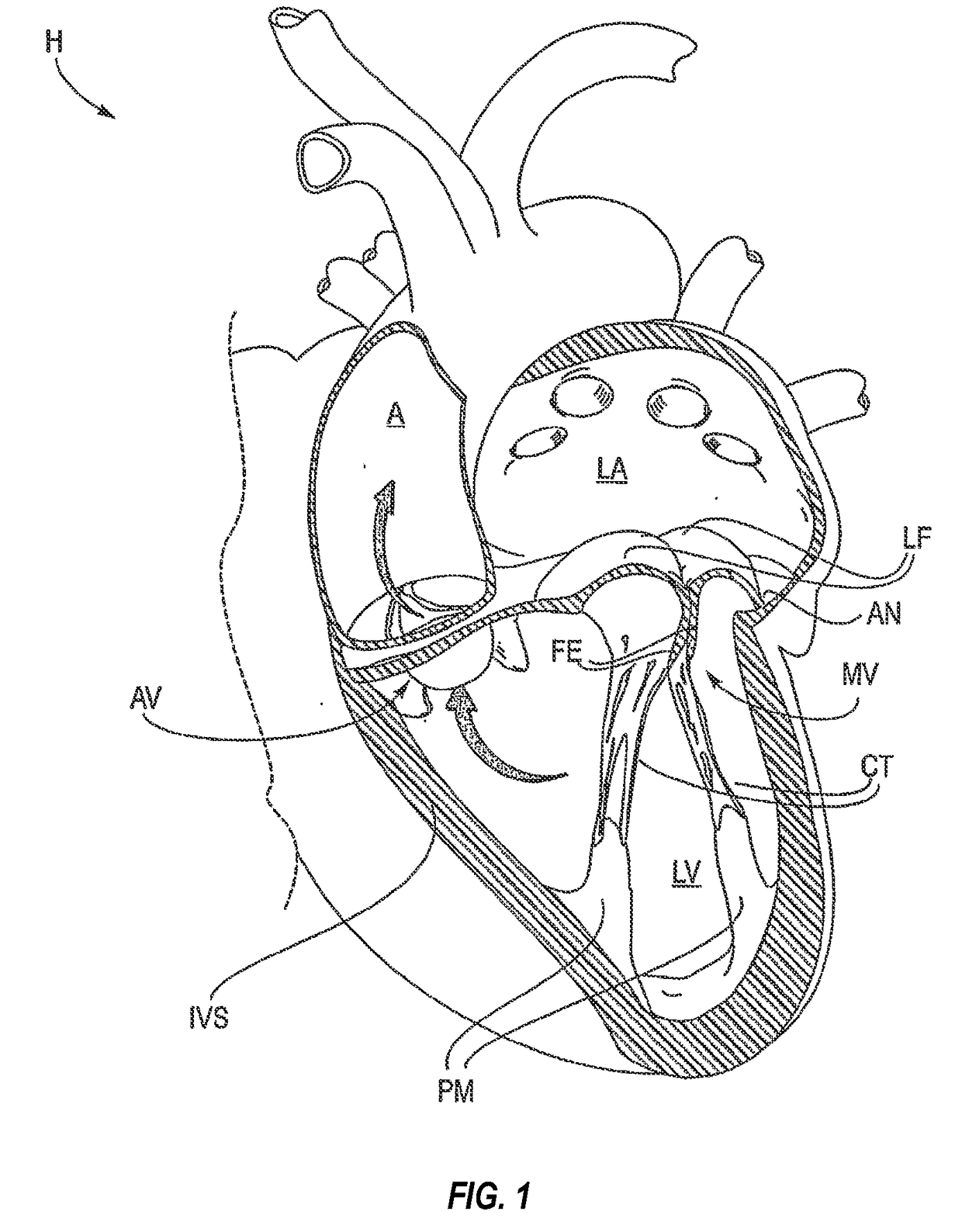 Mitral valve fixation device removal devices and methods