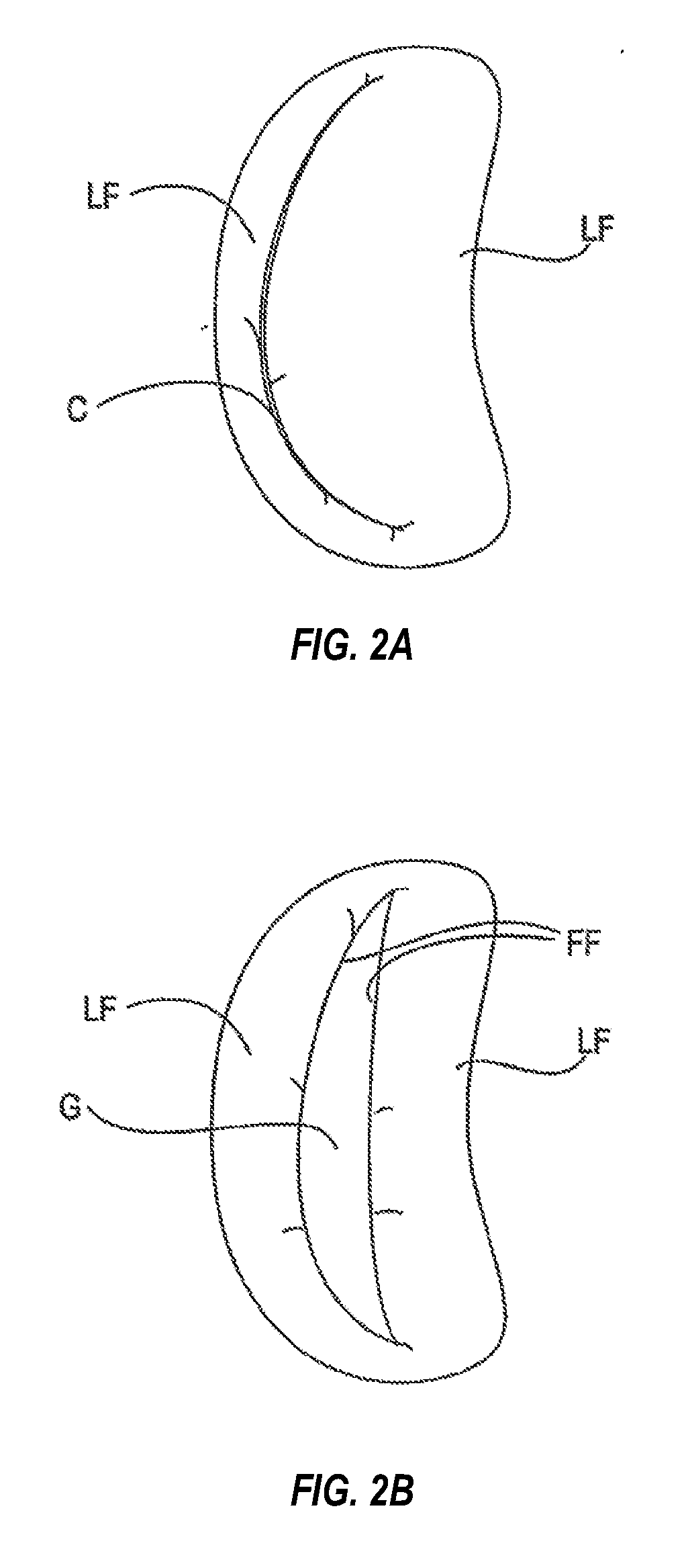 Mitral valve fixation device removal devices and methods