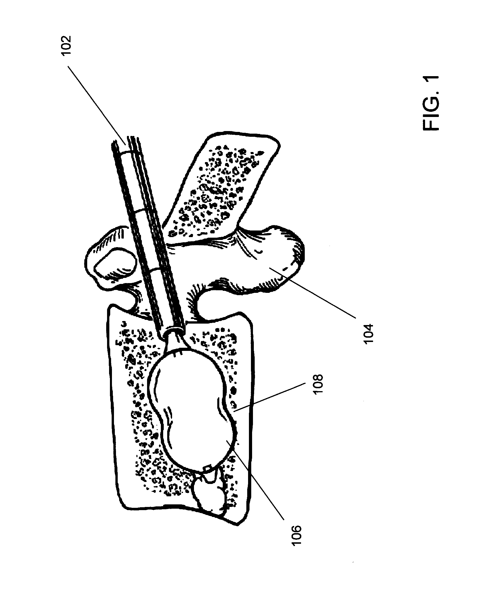 Biologic balloon and method of use