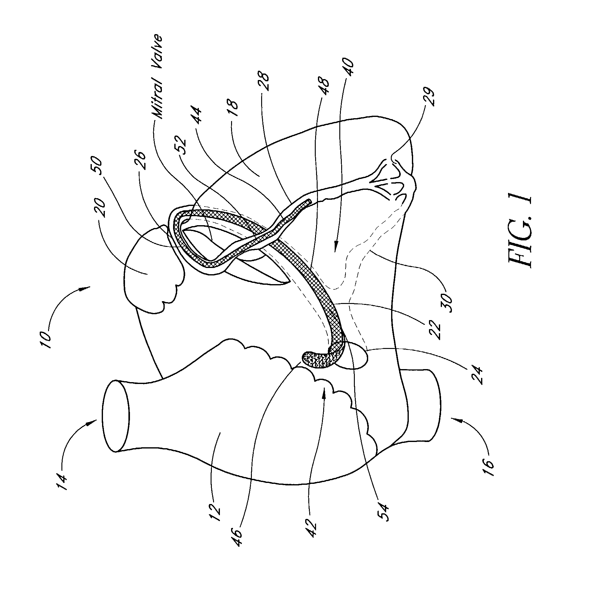 Medical system and method for remodeling an extravascular tissue structure